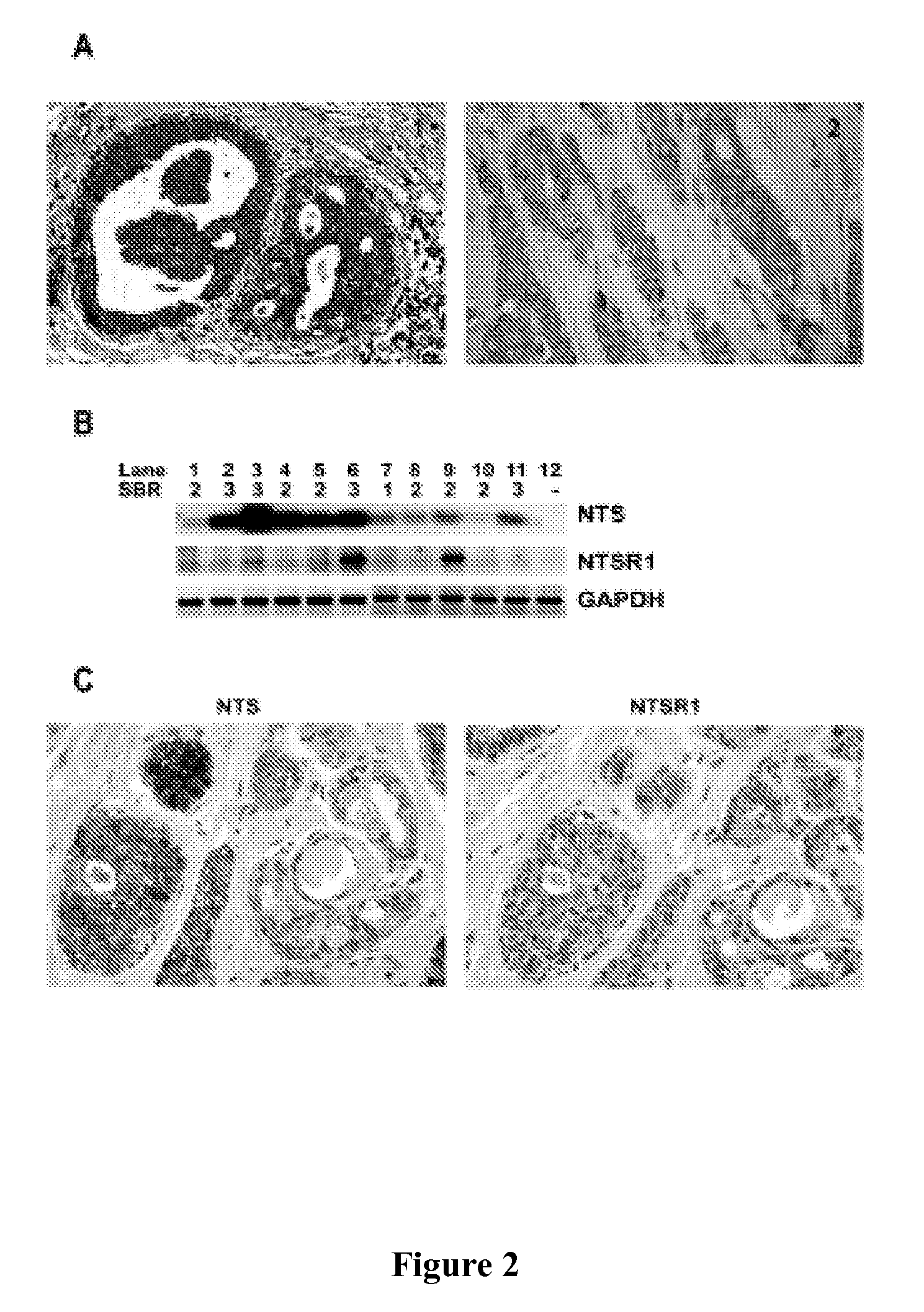 Methods for treating breast cancer with inhibitors of neurotensin activation of NTSR1