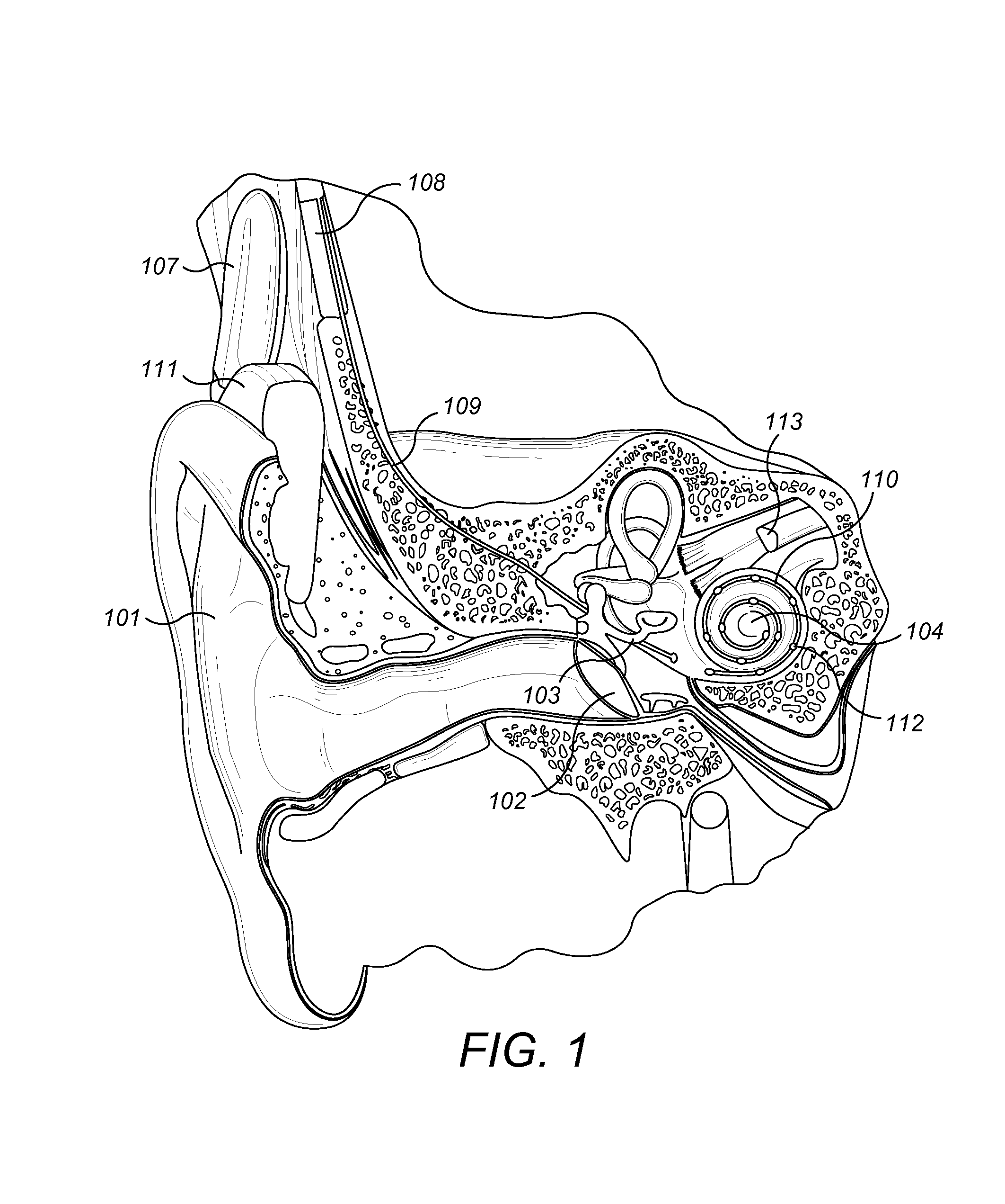 Deployable and Multi-Sectional Hearing Implant Electrode