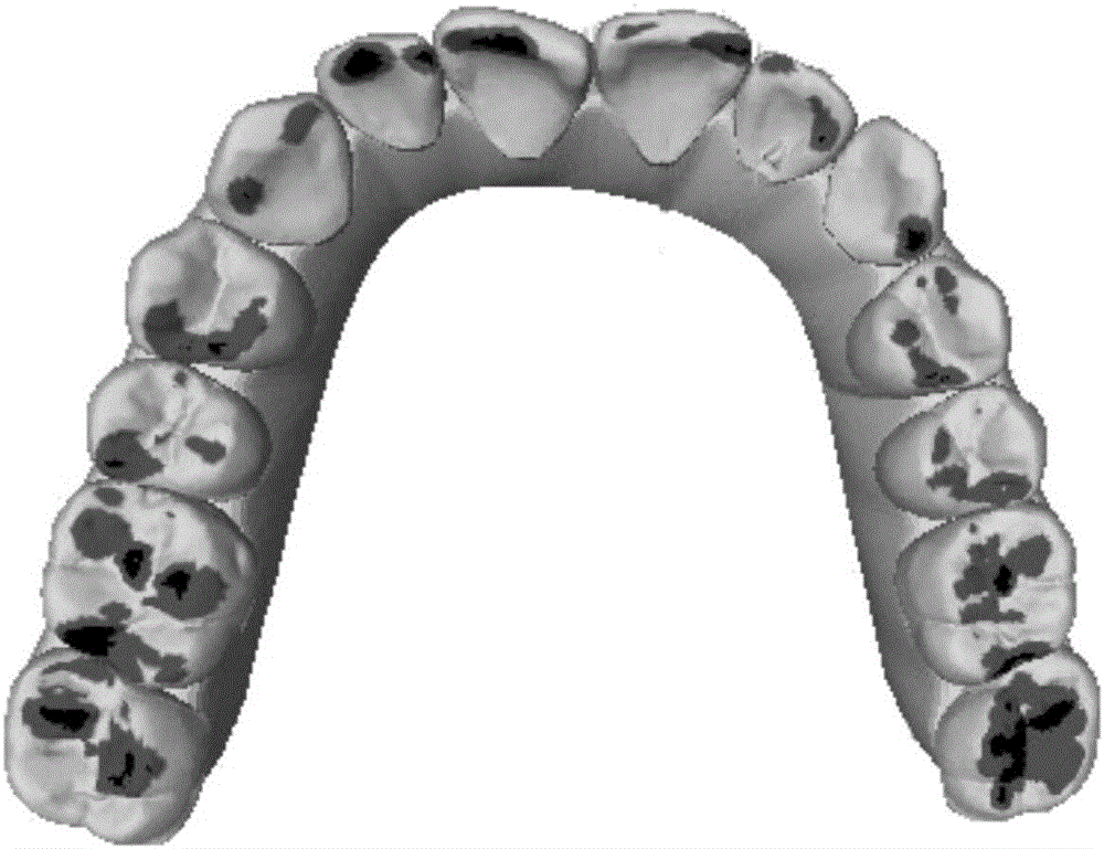 Collision detection algorithm for calculating occlusion areas of upper and lower jaws
