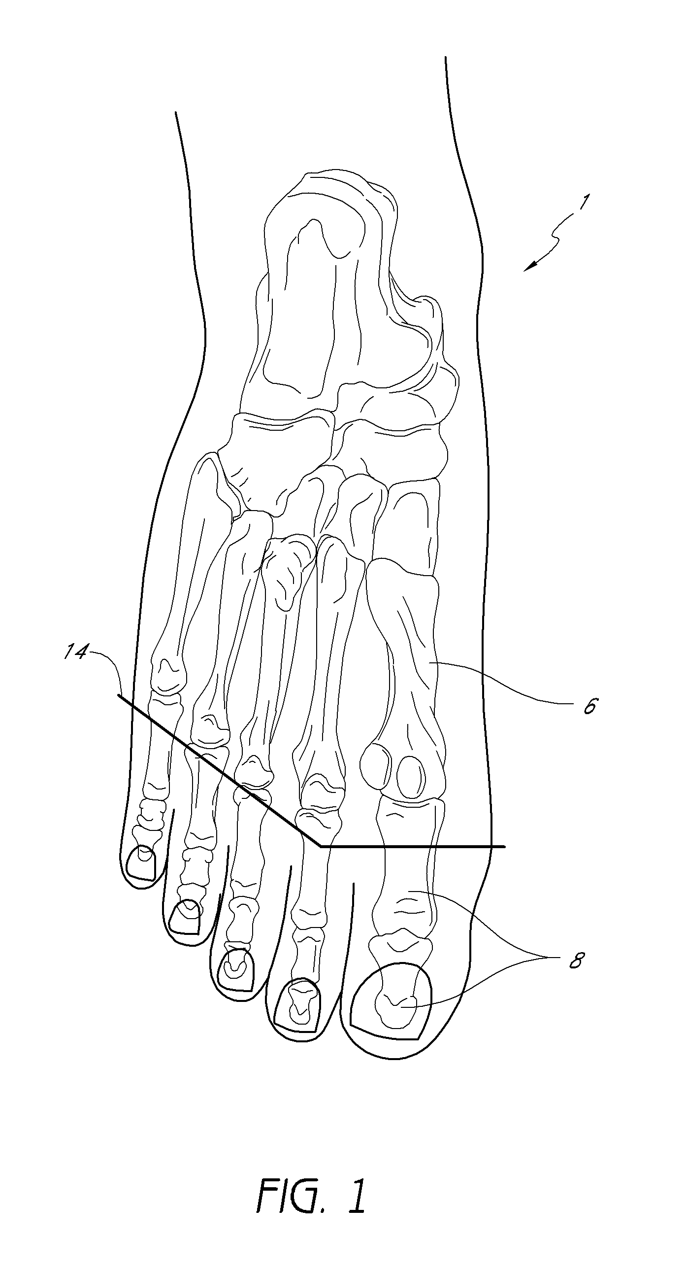 Metatarsal joint shape for prosthetic foot and control mechanism and system for same