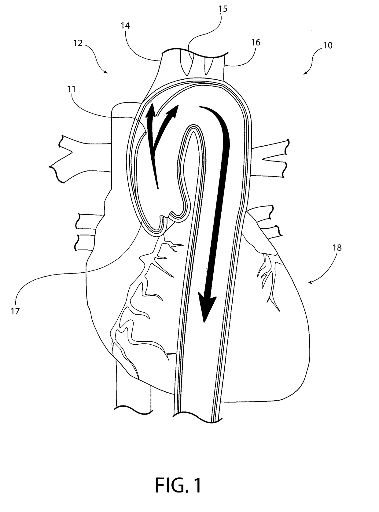 Intravascular device for hemiarch repair and associated method