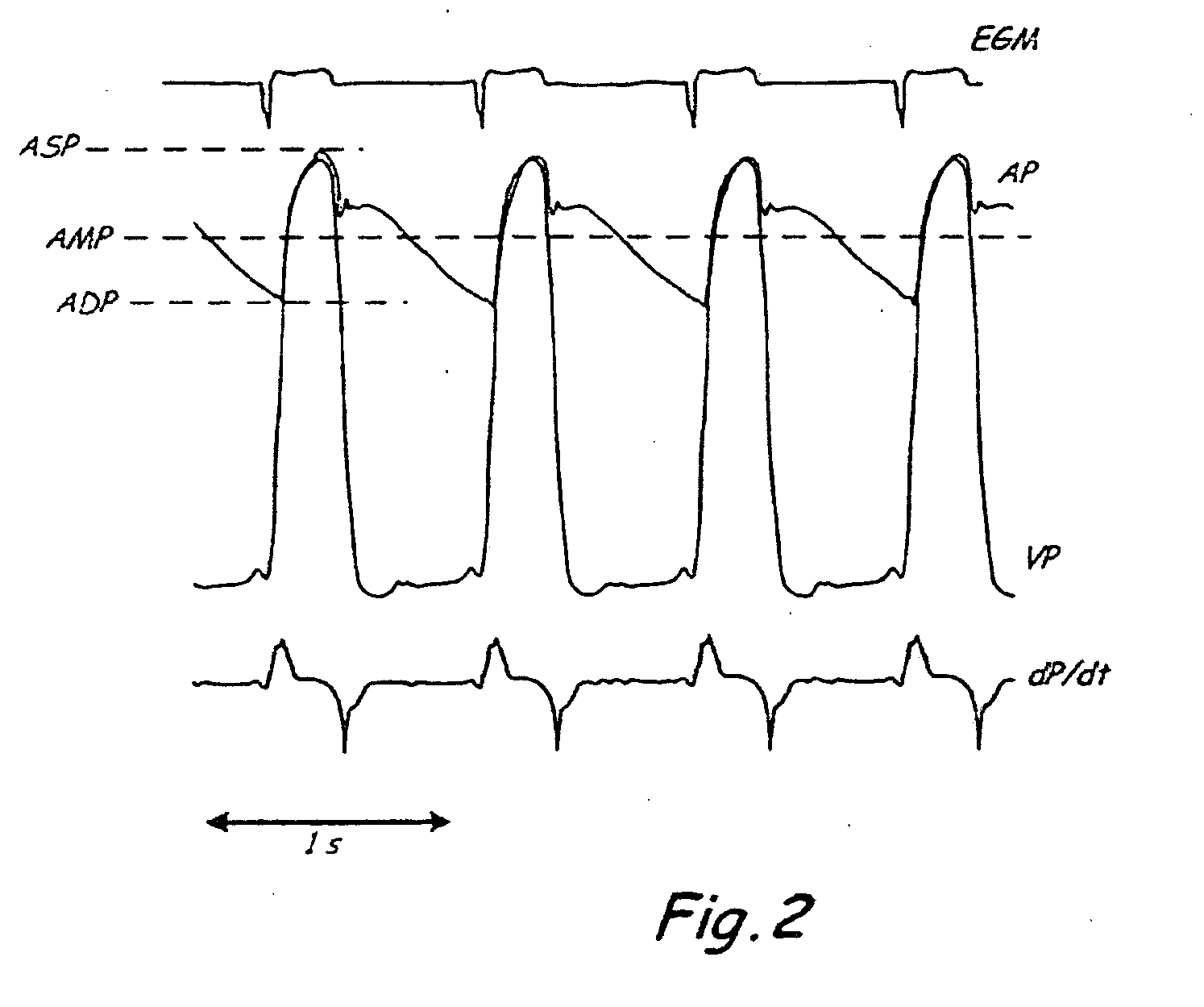 System and method of determining arterial blood pressure and ventricular fill parameters from ventricular blood pressure waveform data