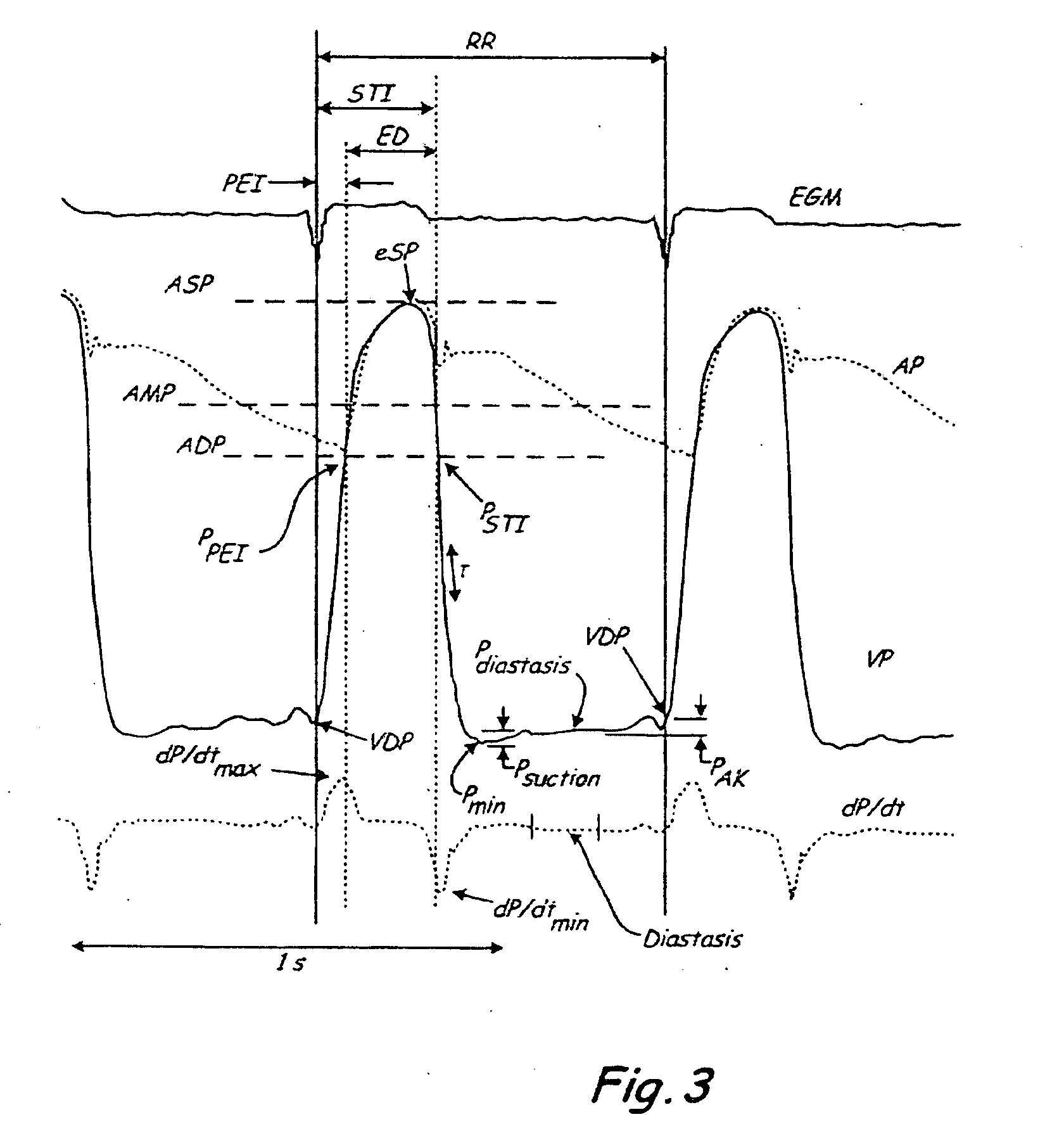 System and method of determining arterial blood pressure and ventricular fill parameters from ventricular blood pressure waveform data