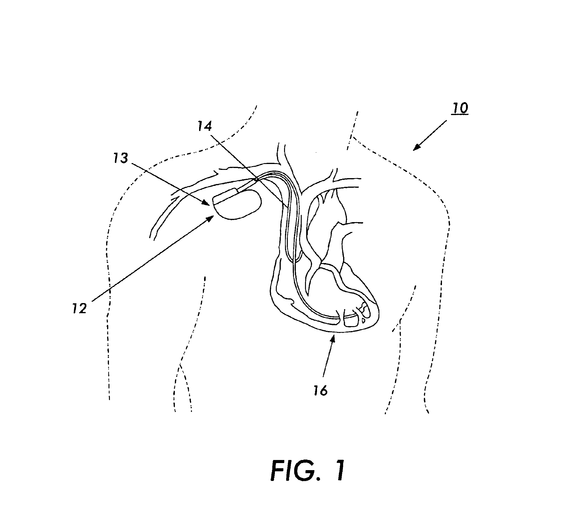 Electromagnetic interference immune tissue invasive system
