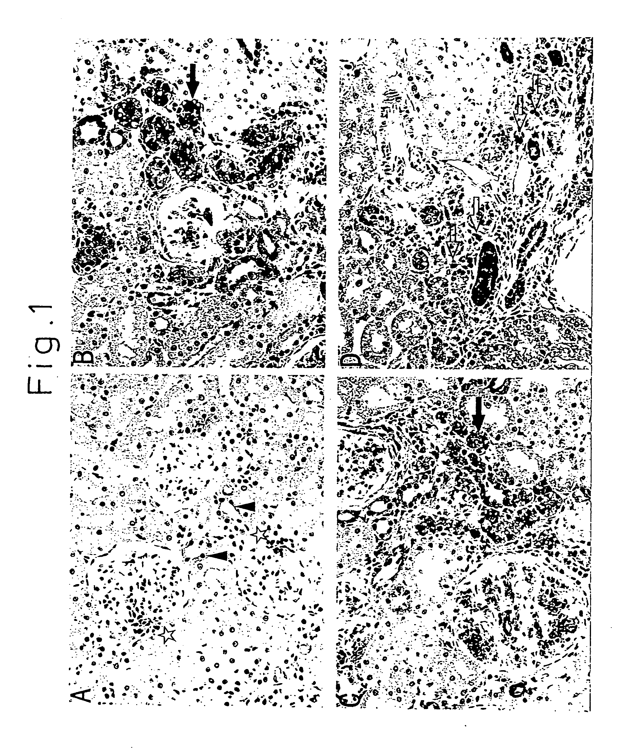 Pharmaceutical composition having inhibitory effect on overproduction and accumulation of extracellular matrix