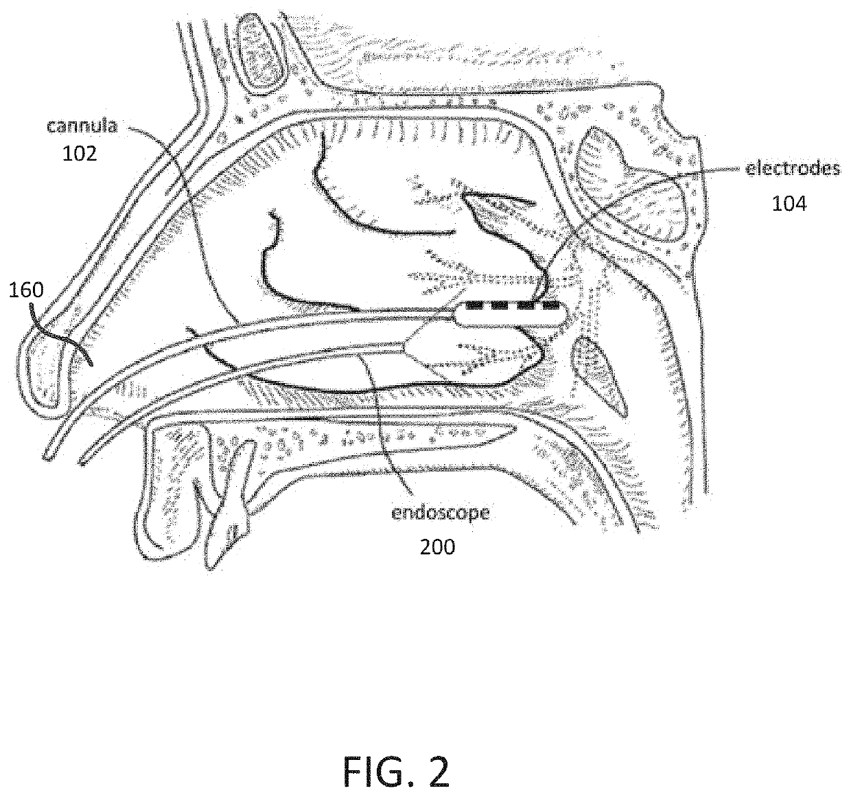 Integrated nasal nerve detector ablation-apparatus, nasal nerve locator, and methods of use