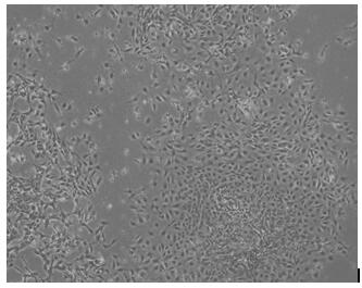 A method for directed differentiation of autologous immune cells into islet cells