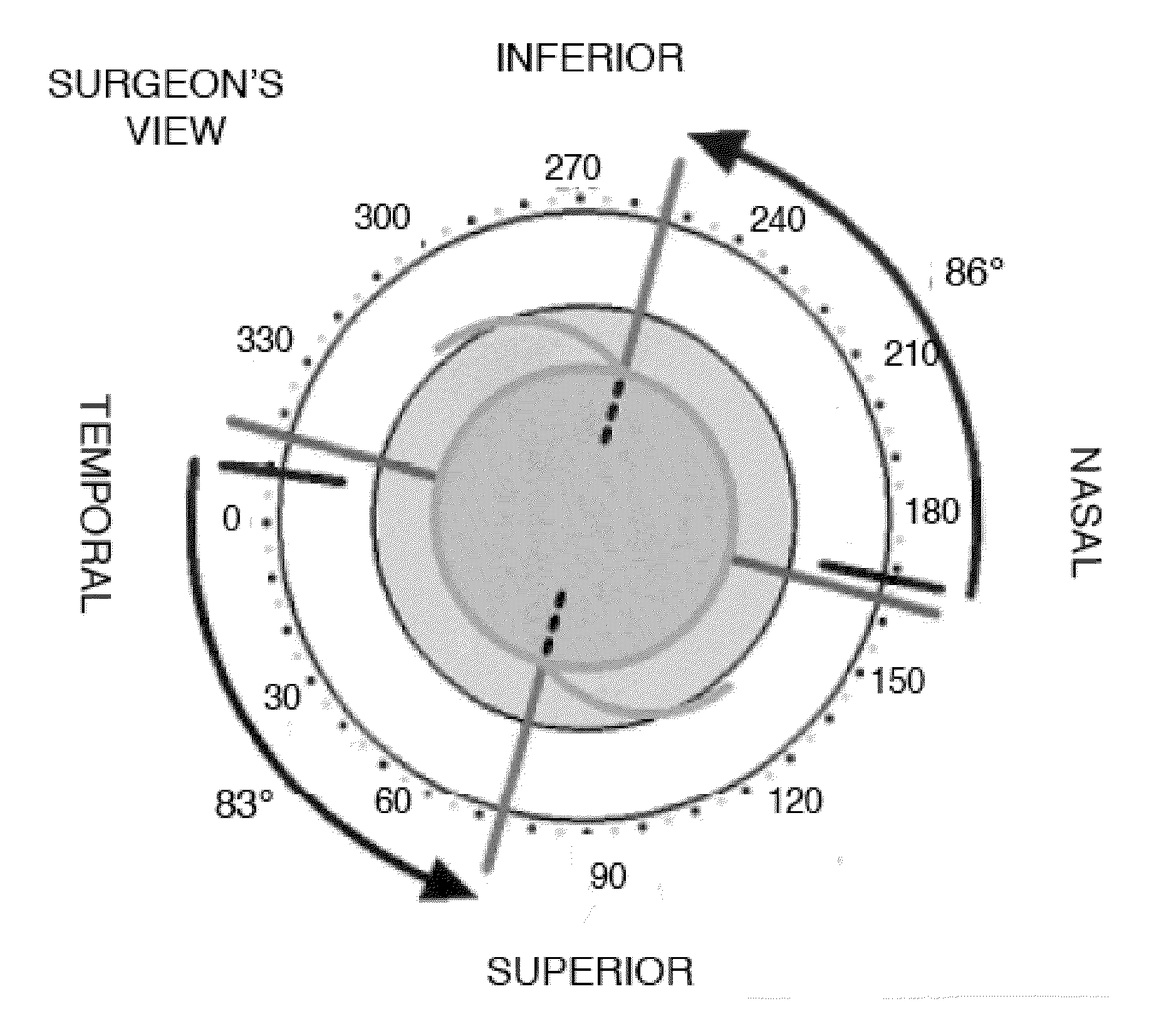 Tools and methods for the surgical placement of intraocular implants