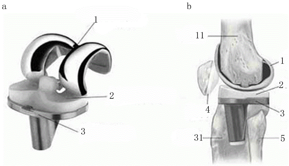 Design method of customized artificial knee joint prosthesis