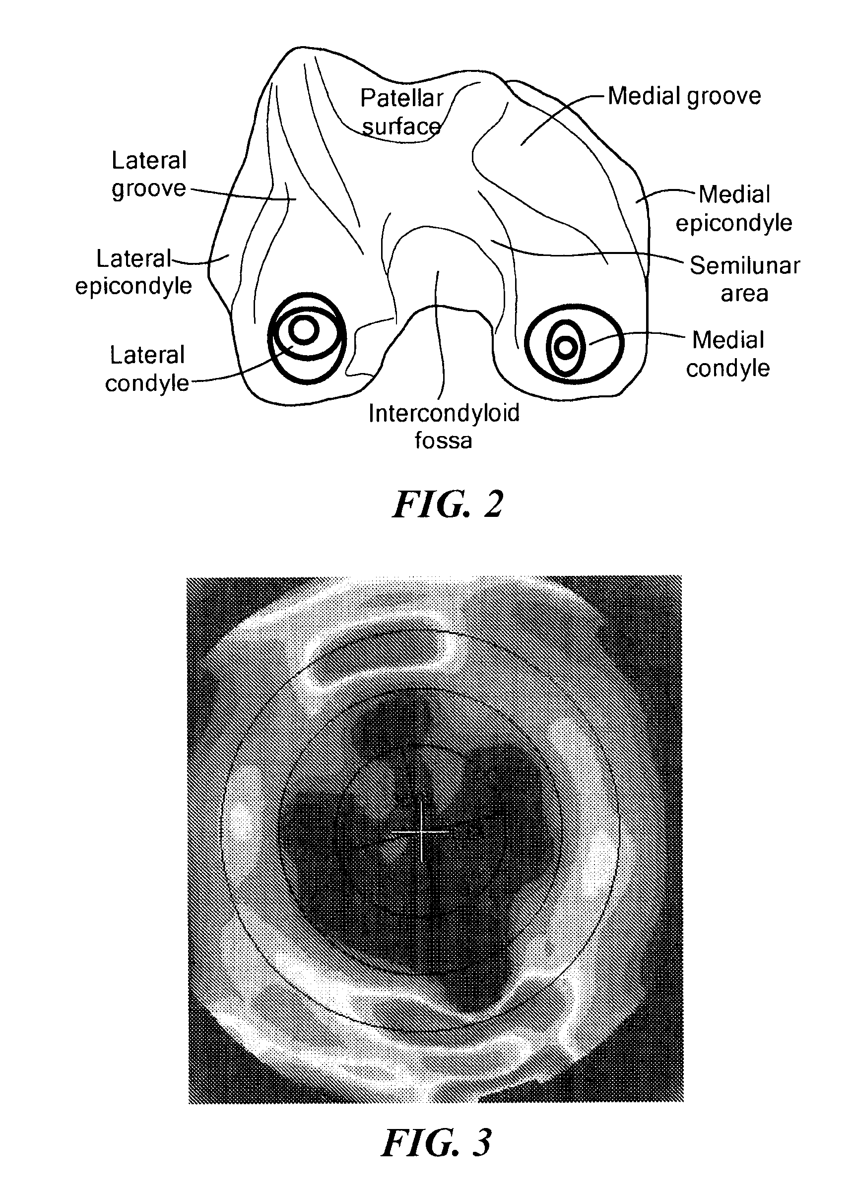 Methods for determining meniscal size and shape and for devising treatment