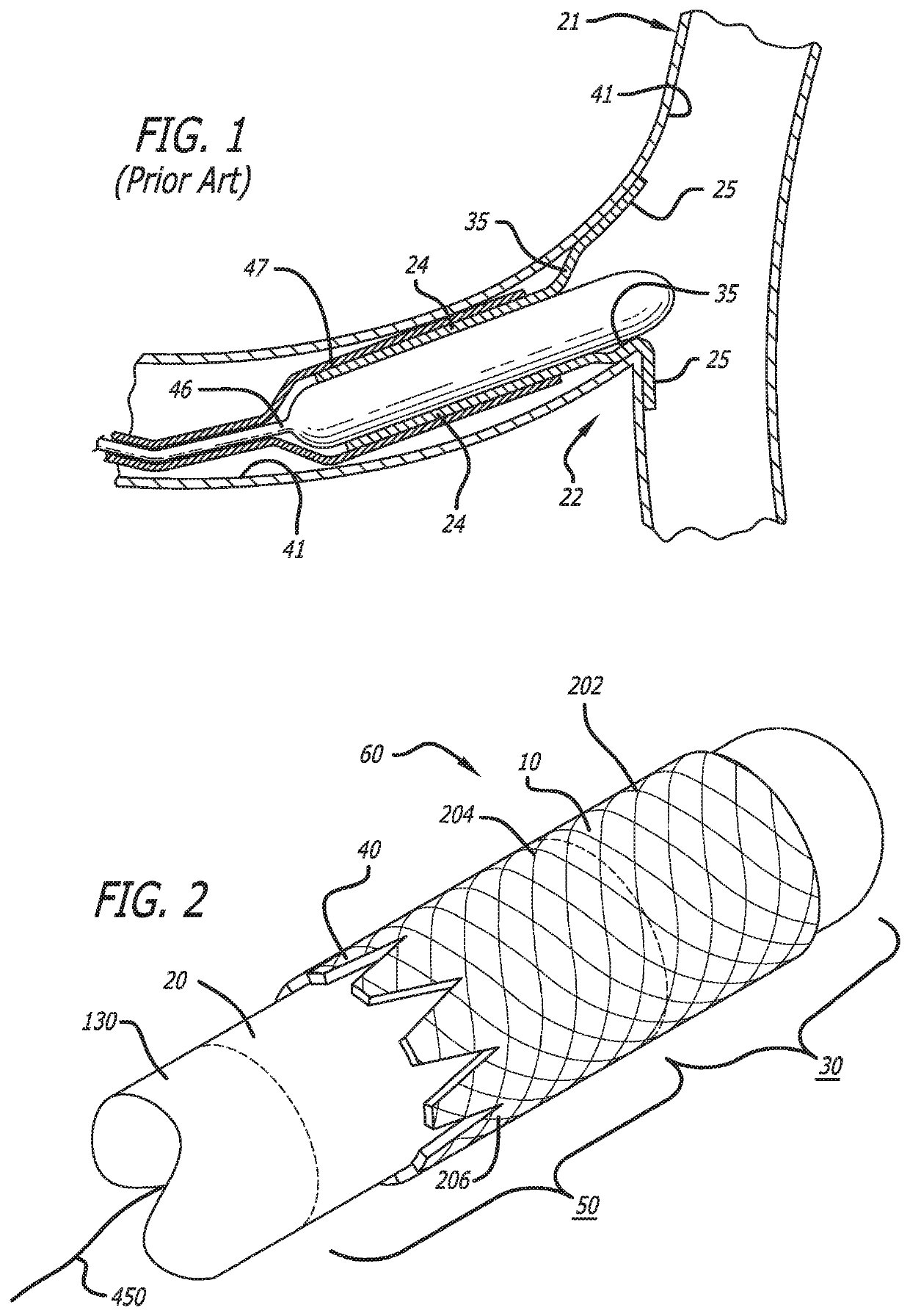 System and method for deploying a proximally-flaring stent