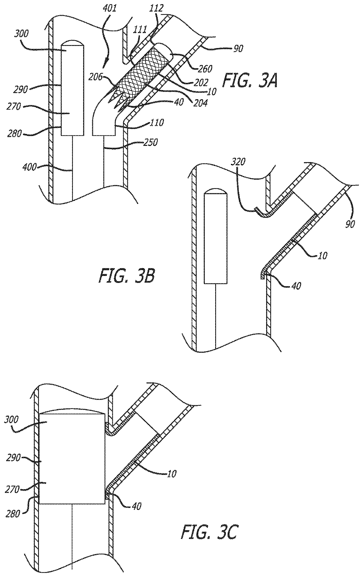 System and method for deploying a proximally-flaring stent