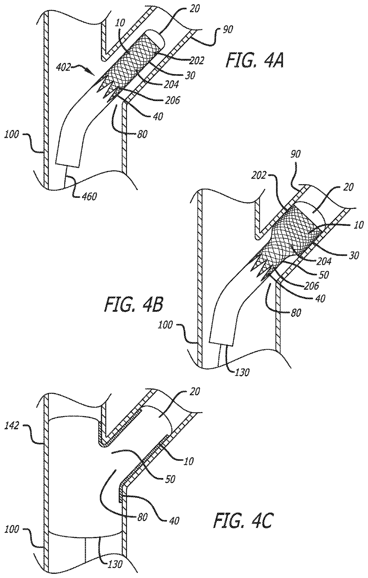 System and method for deploying a proximally-flaring stent