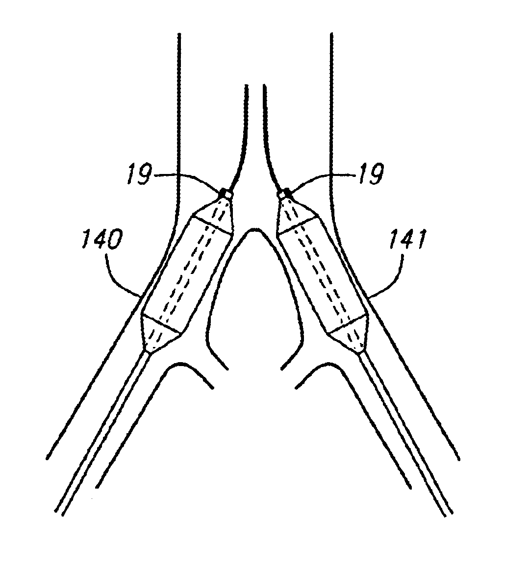 Devices and methods for cerebral perfusion augmentation