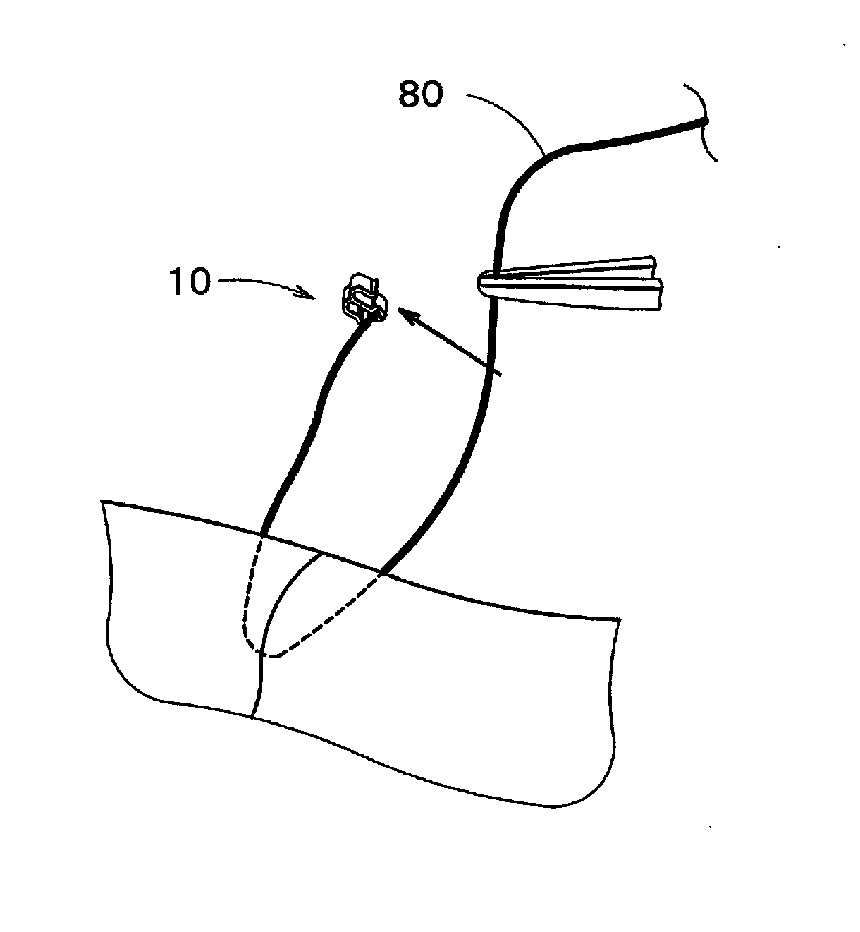 Anatomical-structure-ligating device