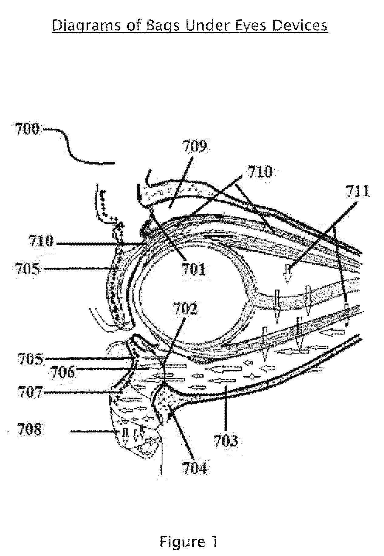 Apparatus and system for treatment and prevention of bags under eyes