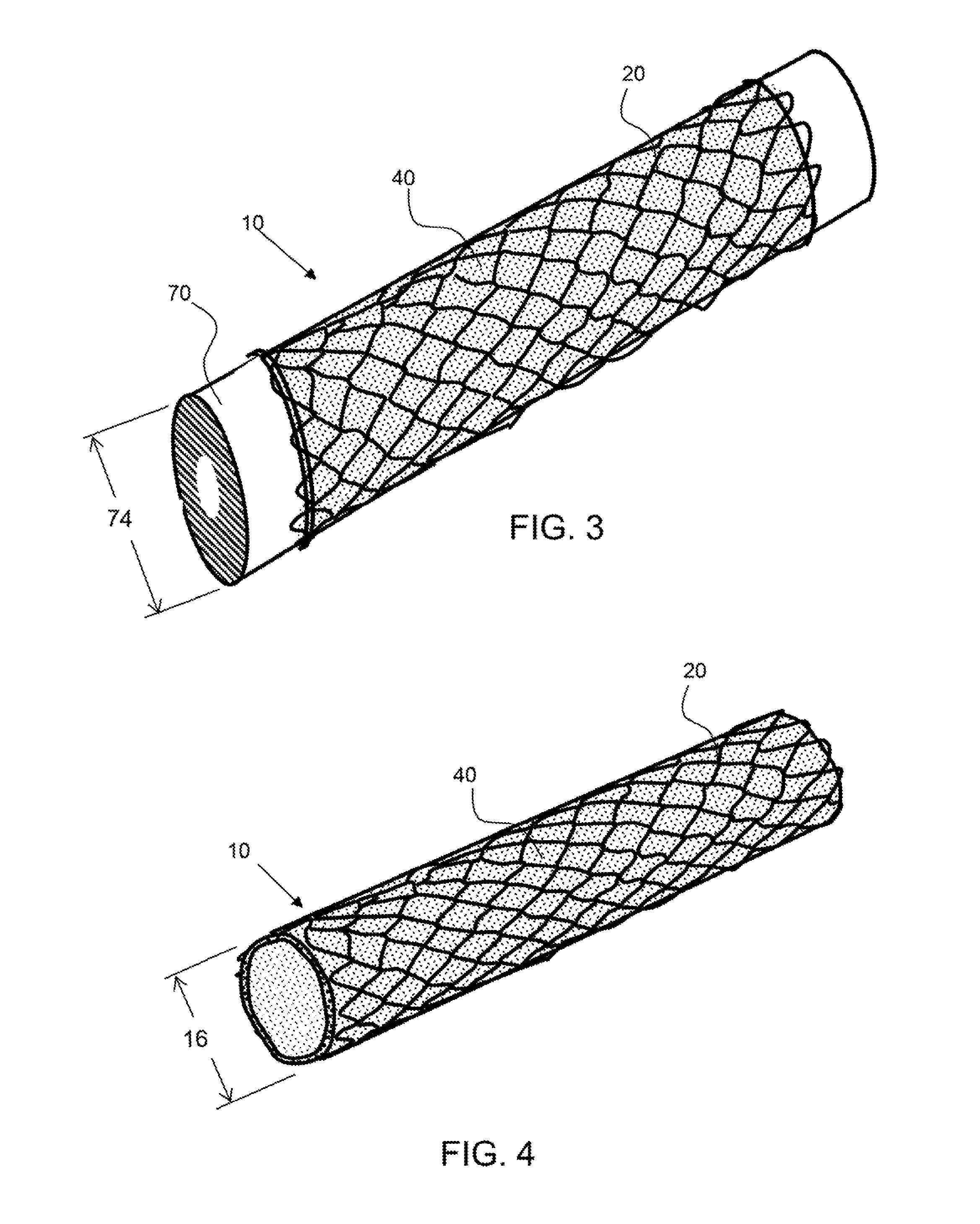 Radially compliant pressure indicating stent graft