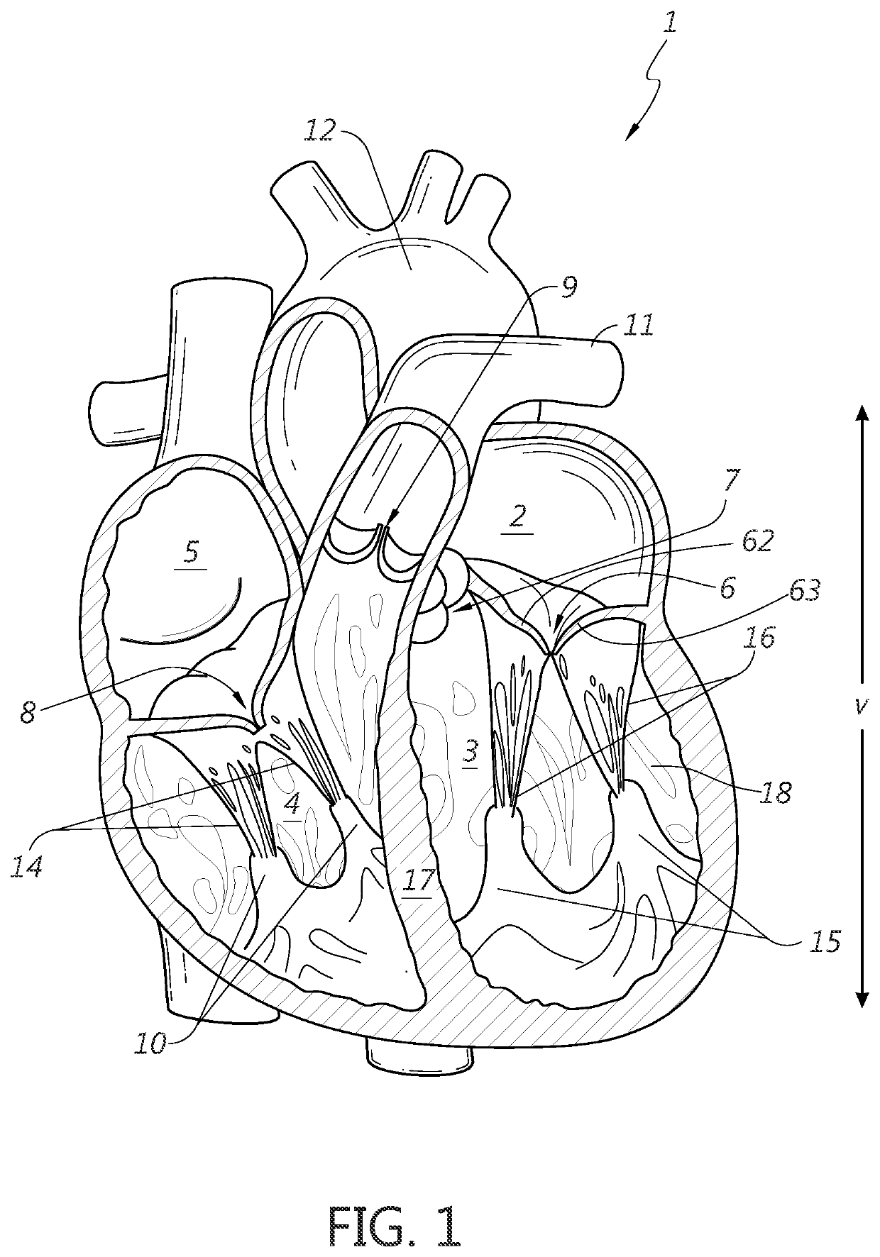 Ventricular remodeling using coil devices