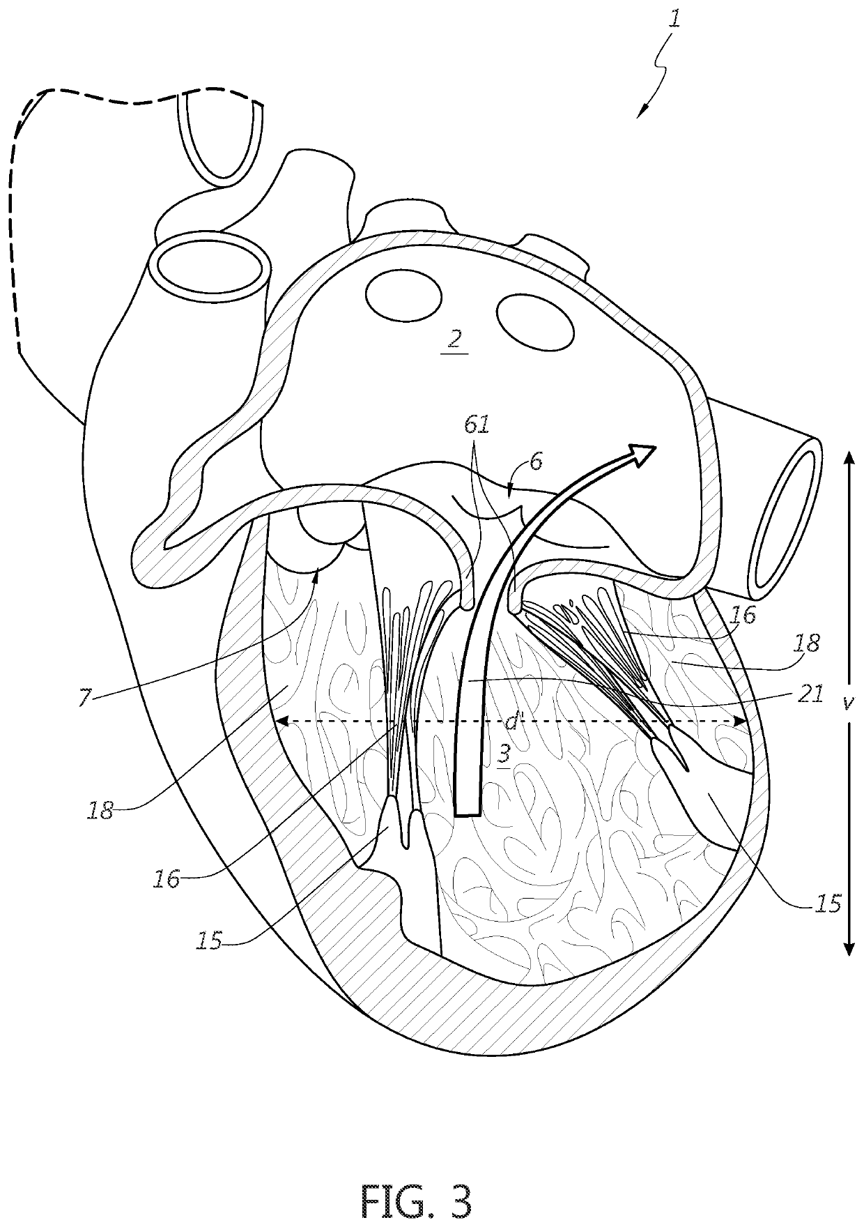 Ventricular remodeling using coil devices