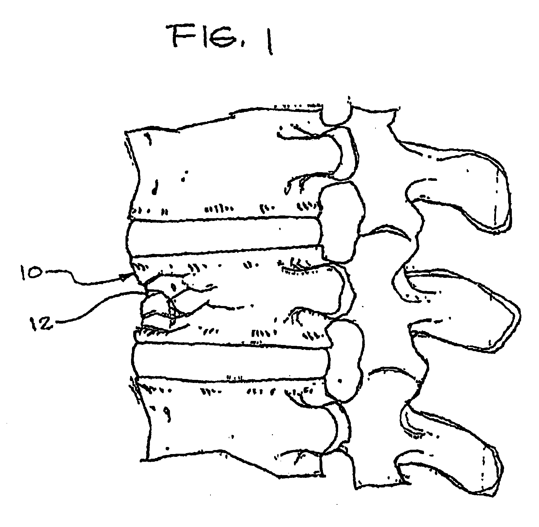 Expandable porous mesh bag device and methods of use for reduction, filling, fixation and supporting of bone