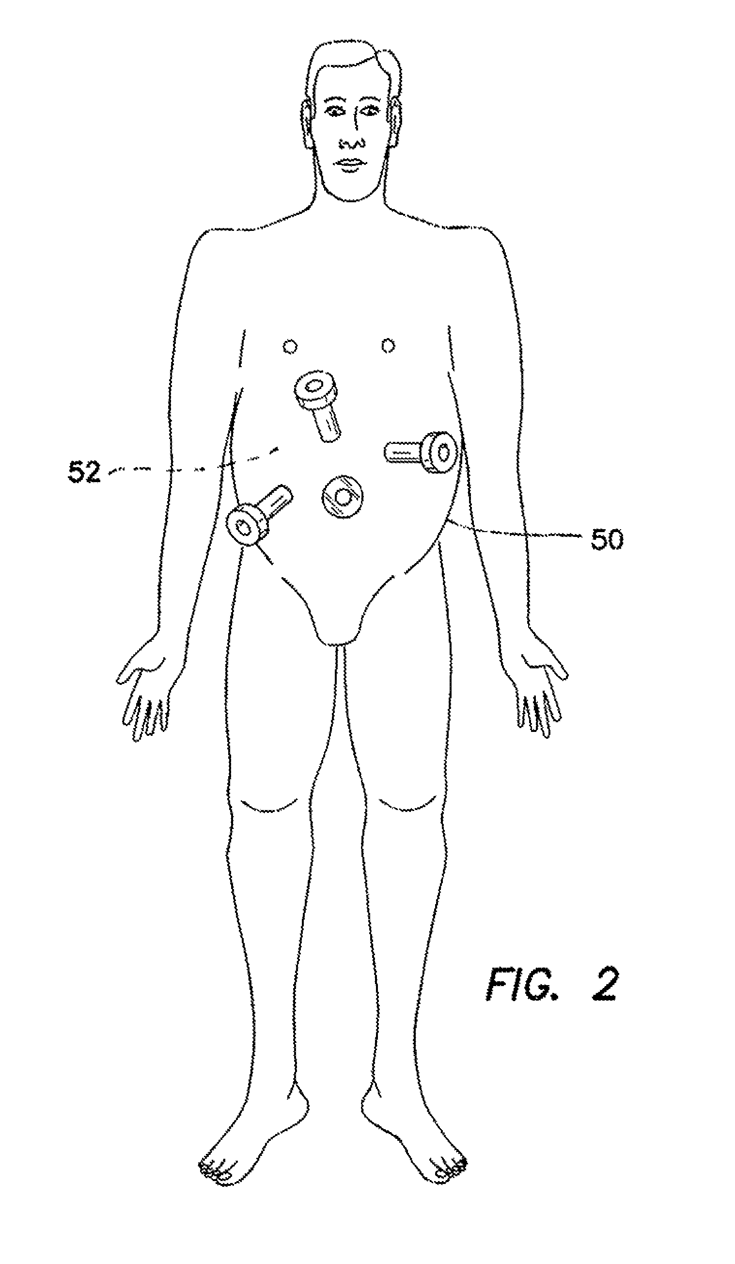 Trocar cannula assembly and method of manufacture