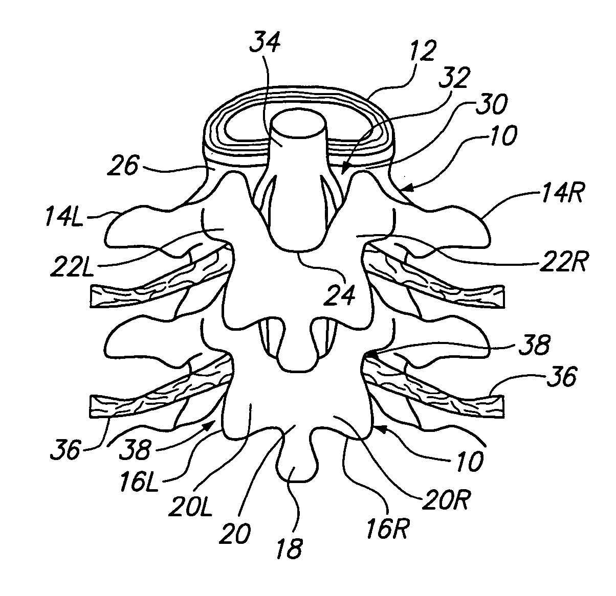 Tissue removal probe with irrigation and aspiration ports