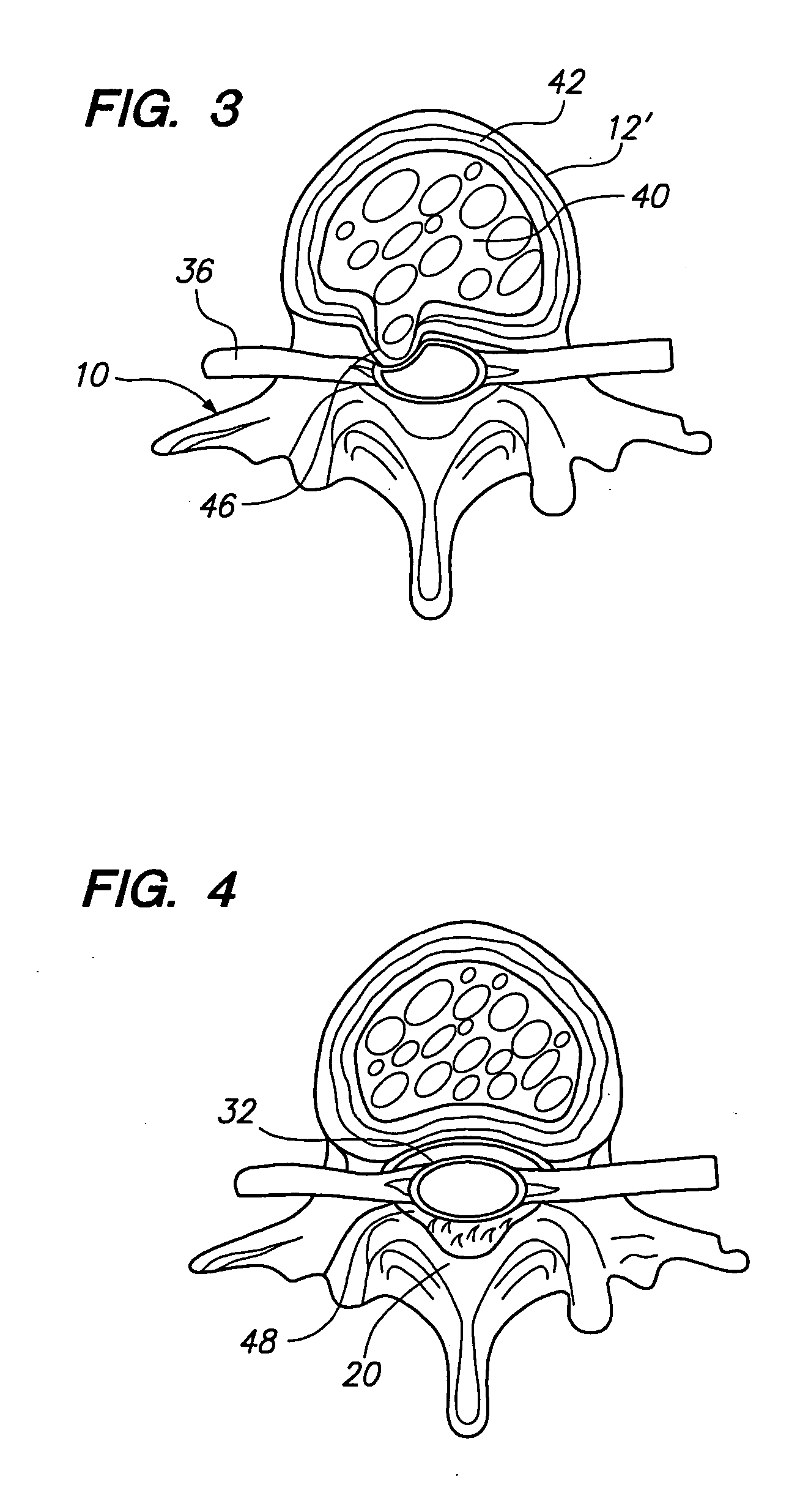 Tissue removal probe with irrigation and aspiration ports