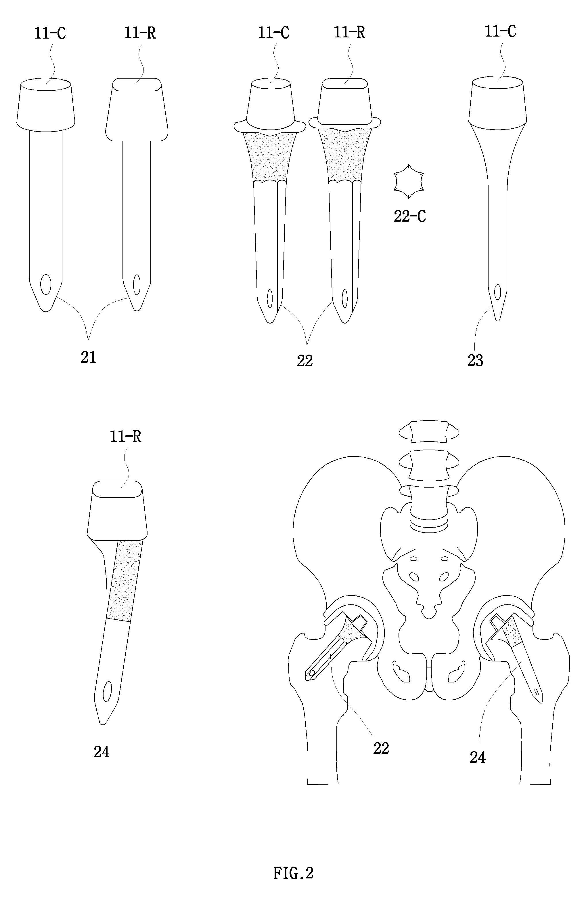 Modular Femoral Head Surface Replacement, Modular Femoral Neck Stem, and Related Sleeve, Adapter, and Osteoconducting Rod