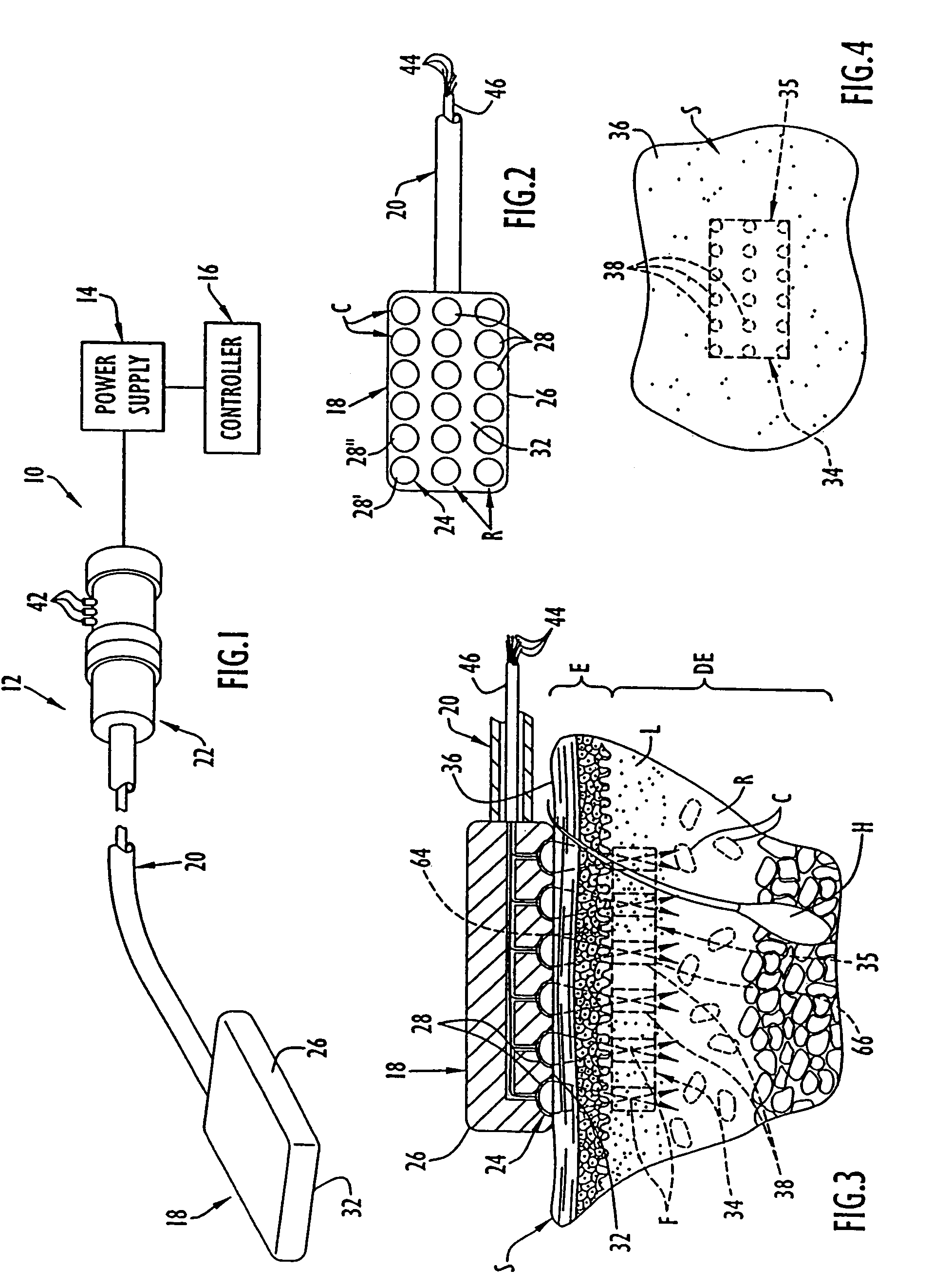 Methods of using high intensity focused ultrasound to form an ablated tissue area