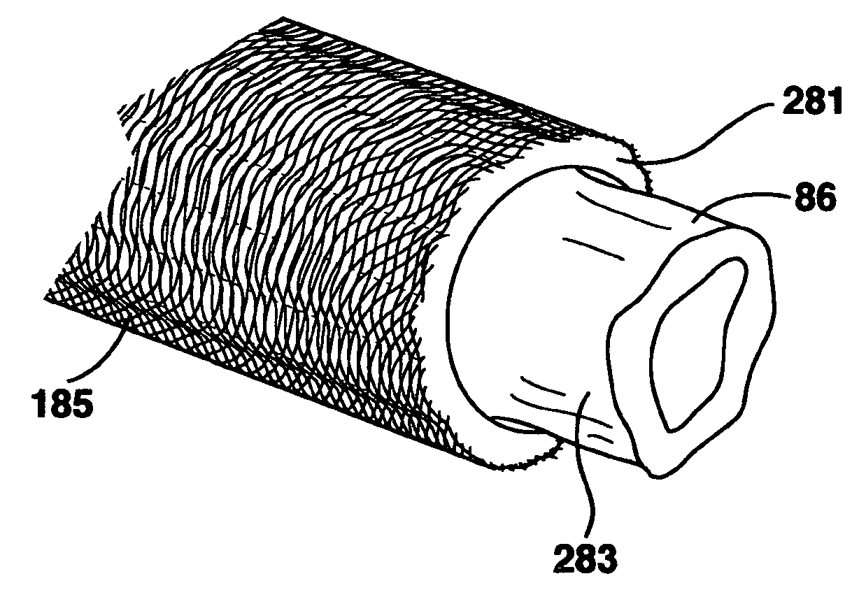 Compliant venous graft