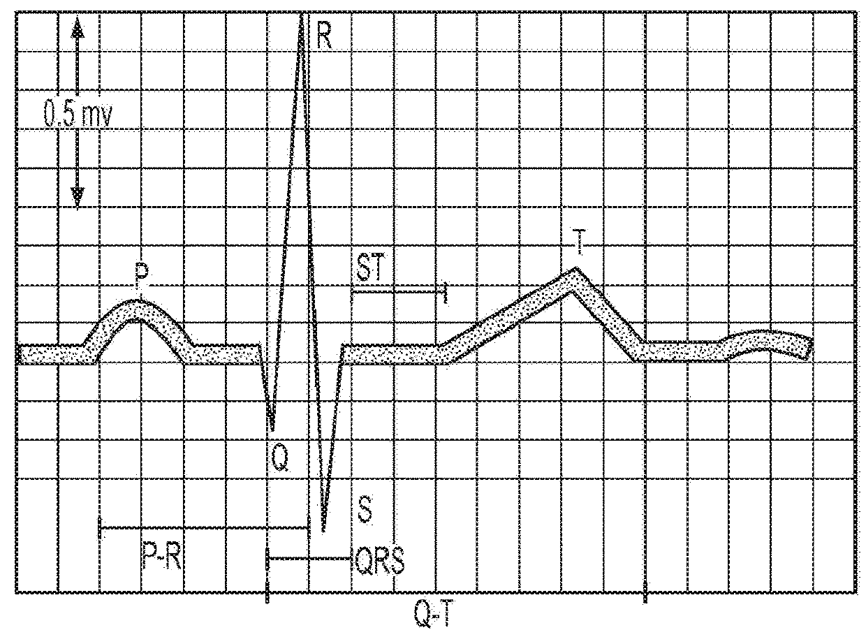 Methods And Systems For Predicting Hypovolemic Hypotensive Conditions Resulting From Bradycardia Behavior Using A Pulse Volume Waveform