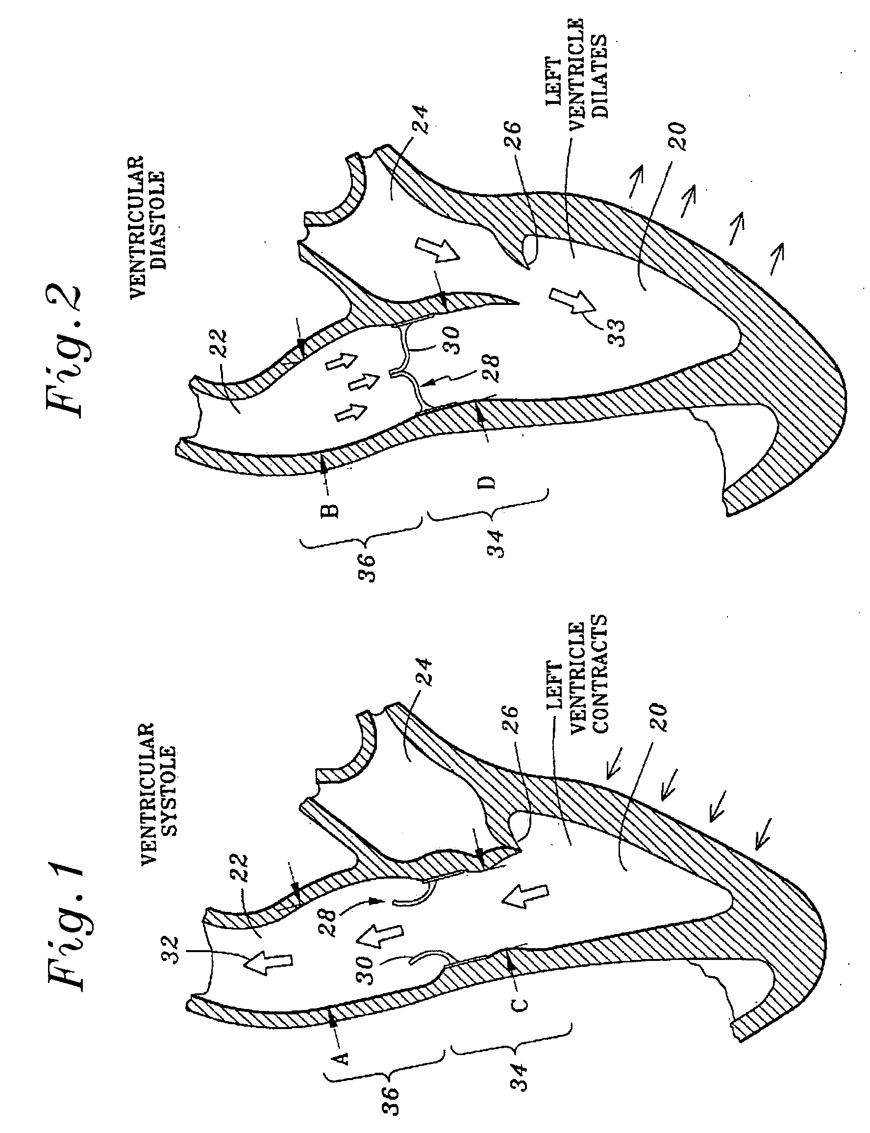 Highly flexible heart valve connecting band