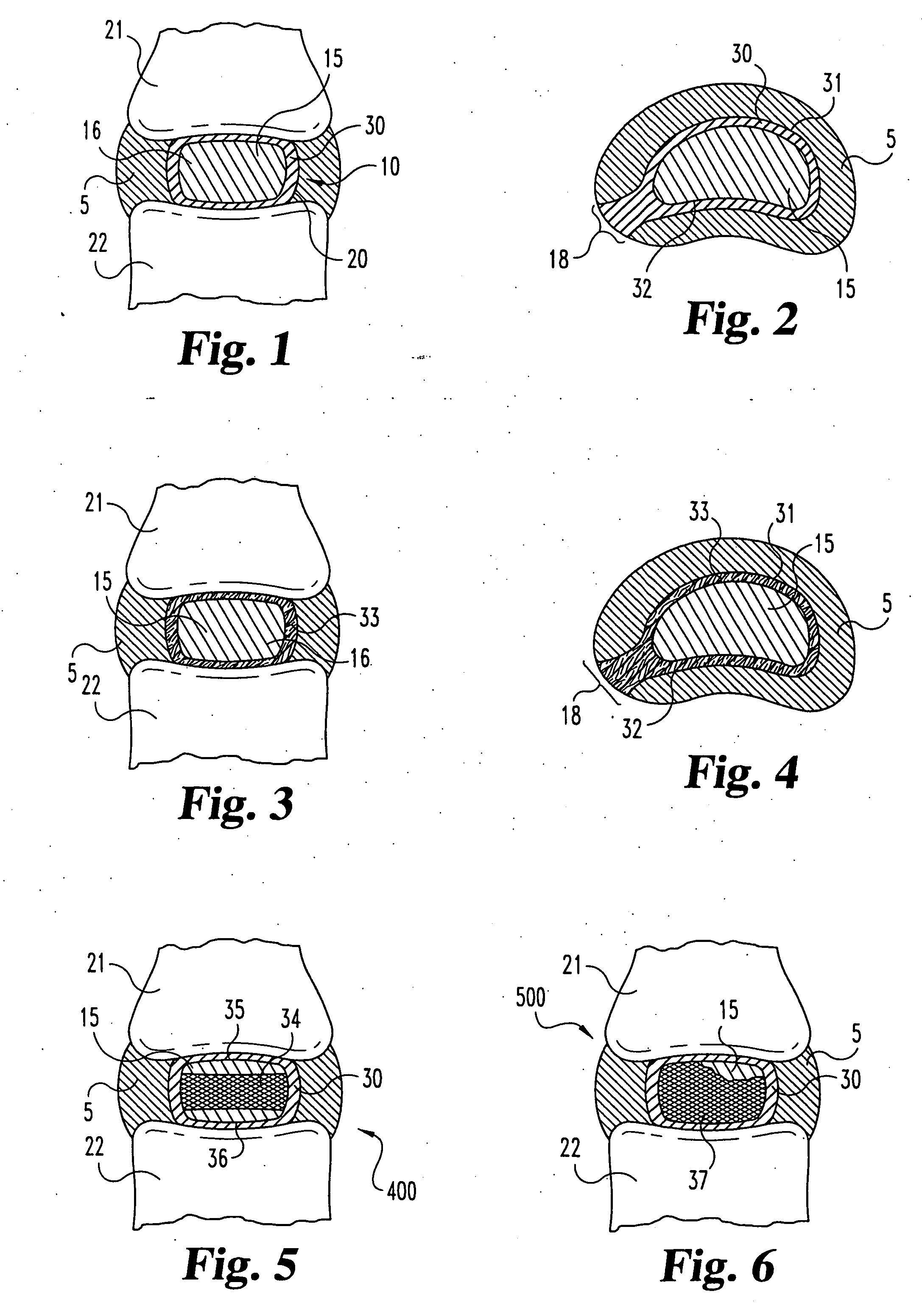 Spinal nucleus replacement implants and methods