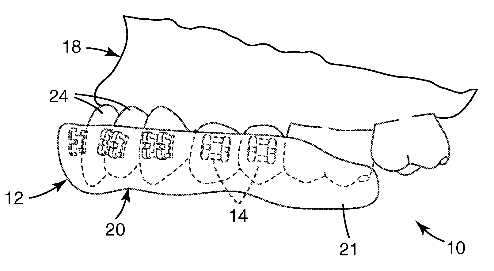 Methods and apparatus for applying dental sealant to an orthodontic patient's teeth