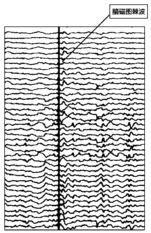 Epilepsy magnetoencephalogram spinous wave automatic detection method and traceability positioning system