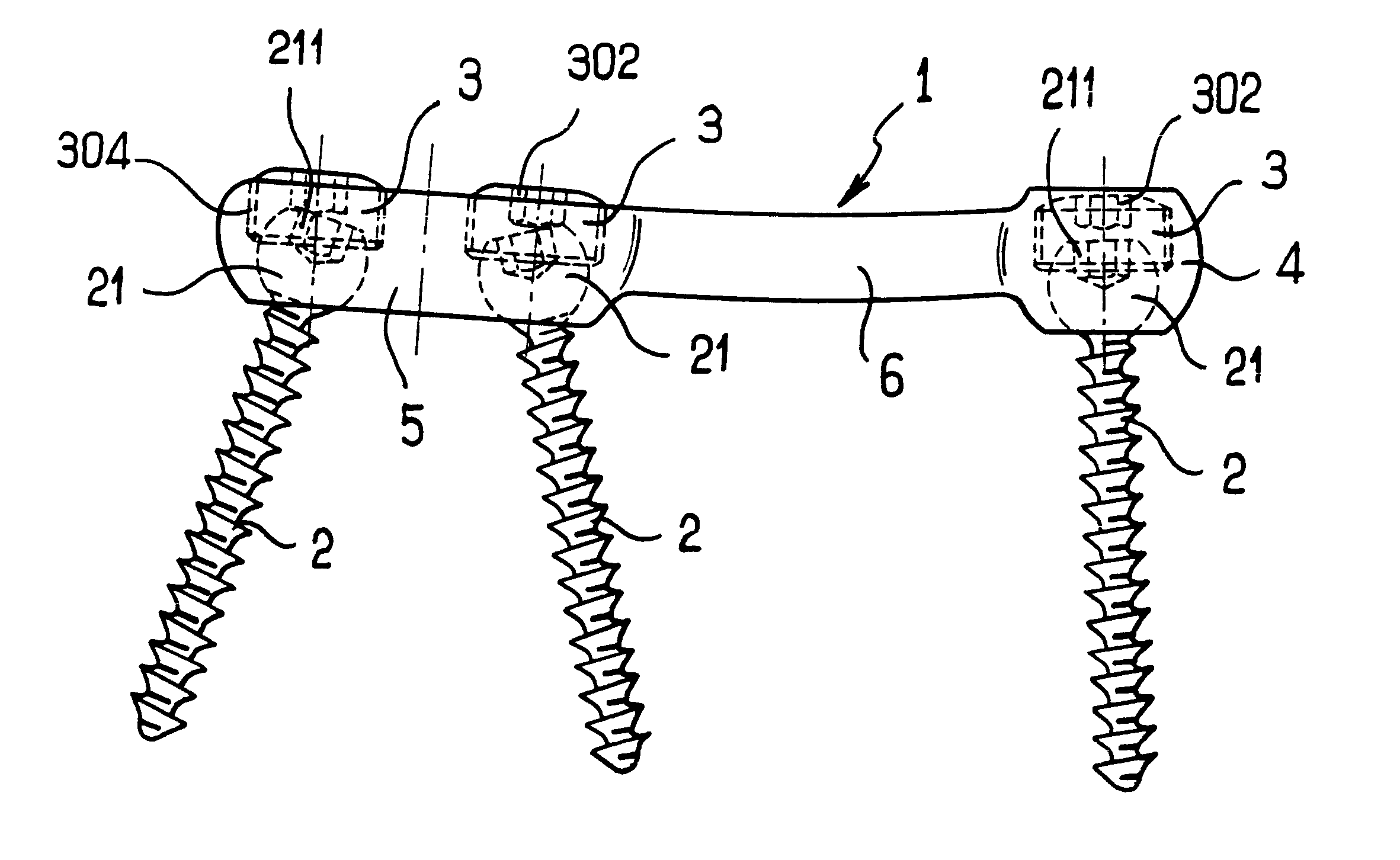 Device for fixing the sacral bone to adjacent vertebrae during osteosynthesis of the backbone