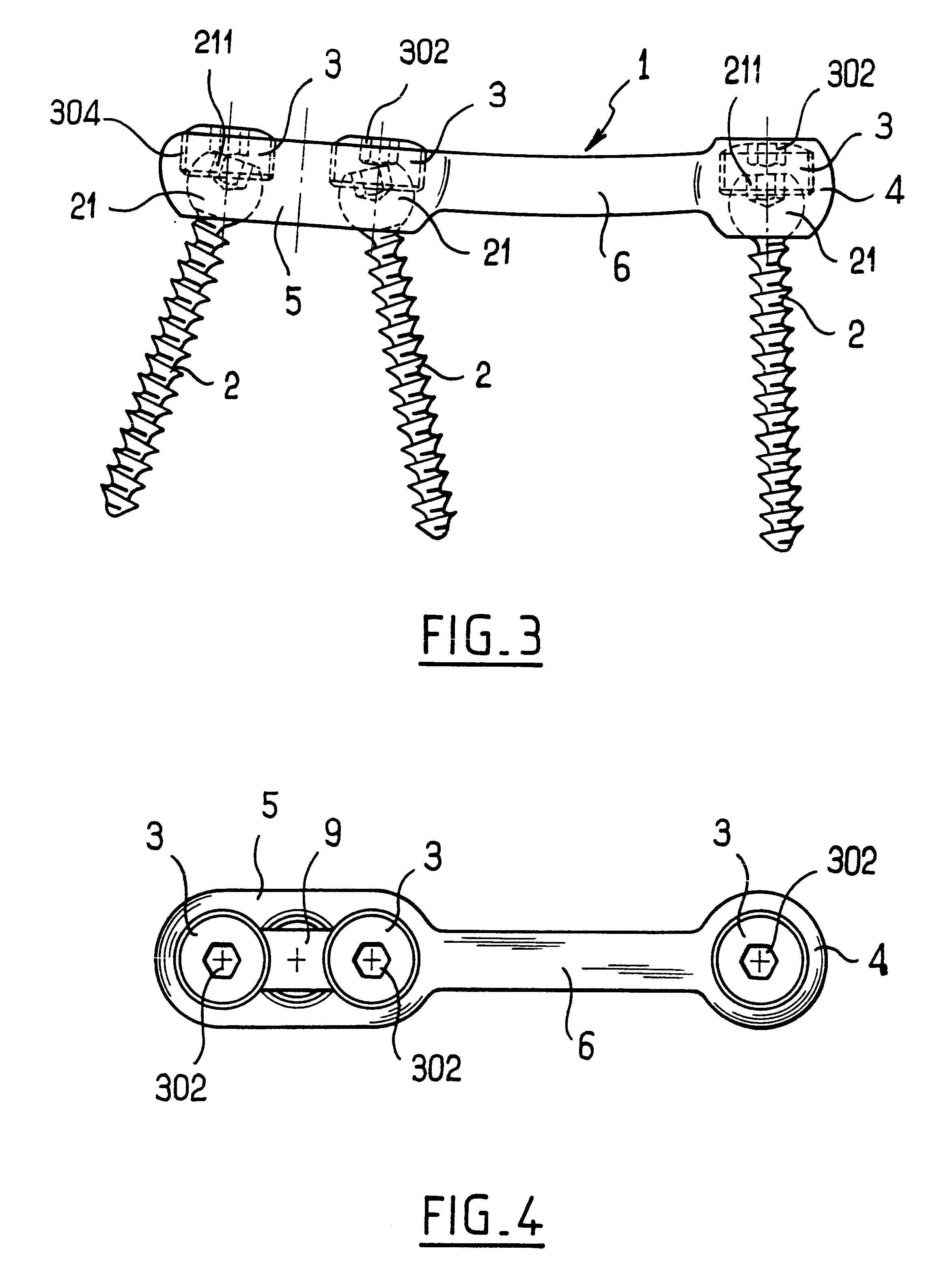 Device for fixing the sacral bone to adjacent vertebrae during osteosynthesis of the backbone