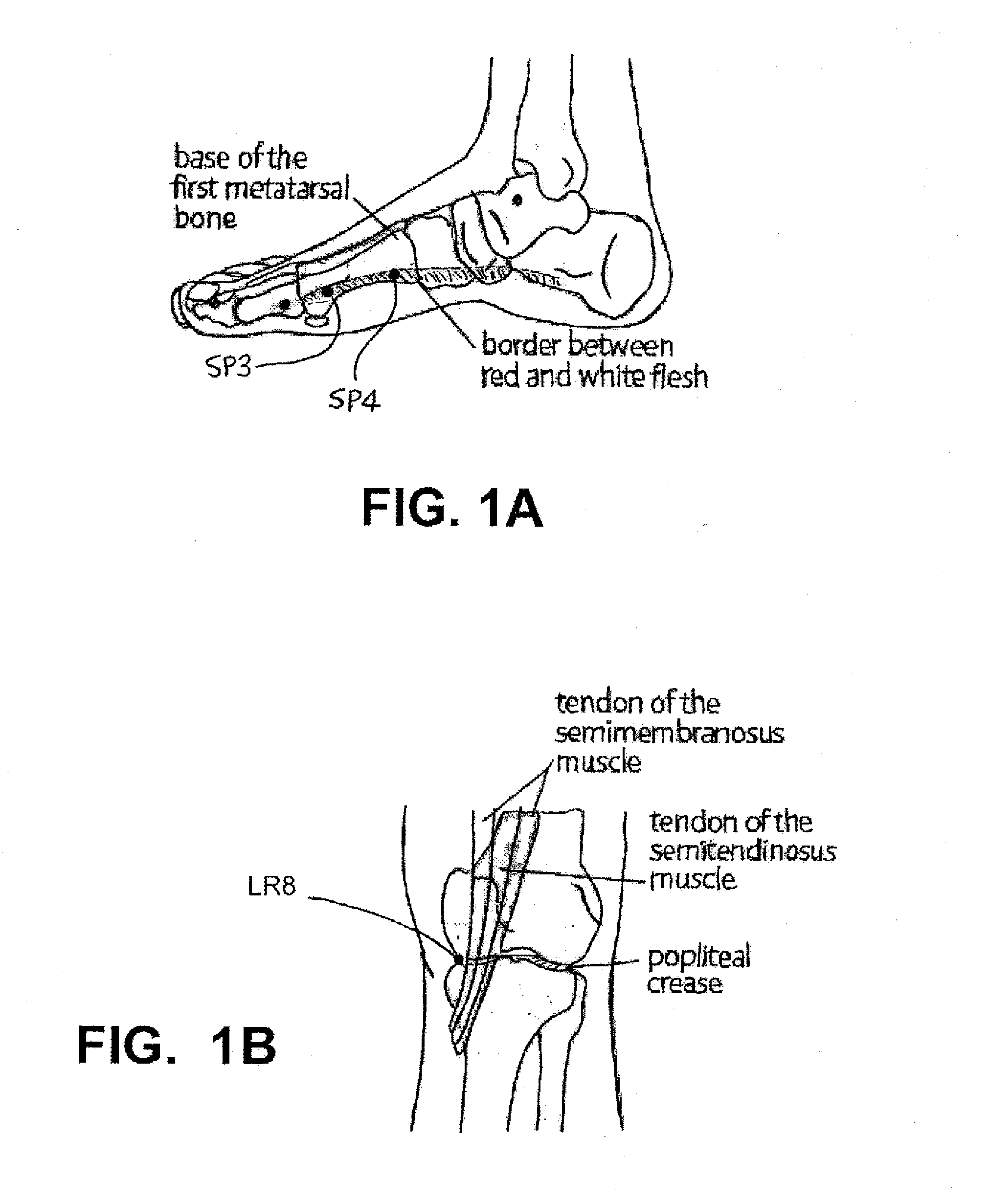 Implantable Electroacupuncture Device and Method for Treating Obesity