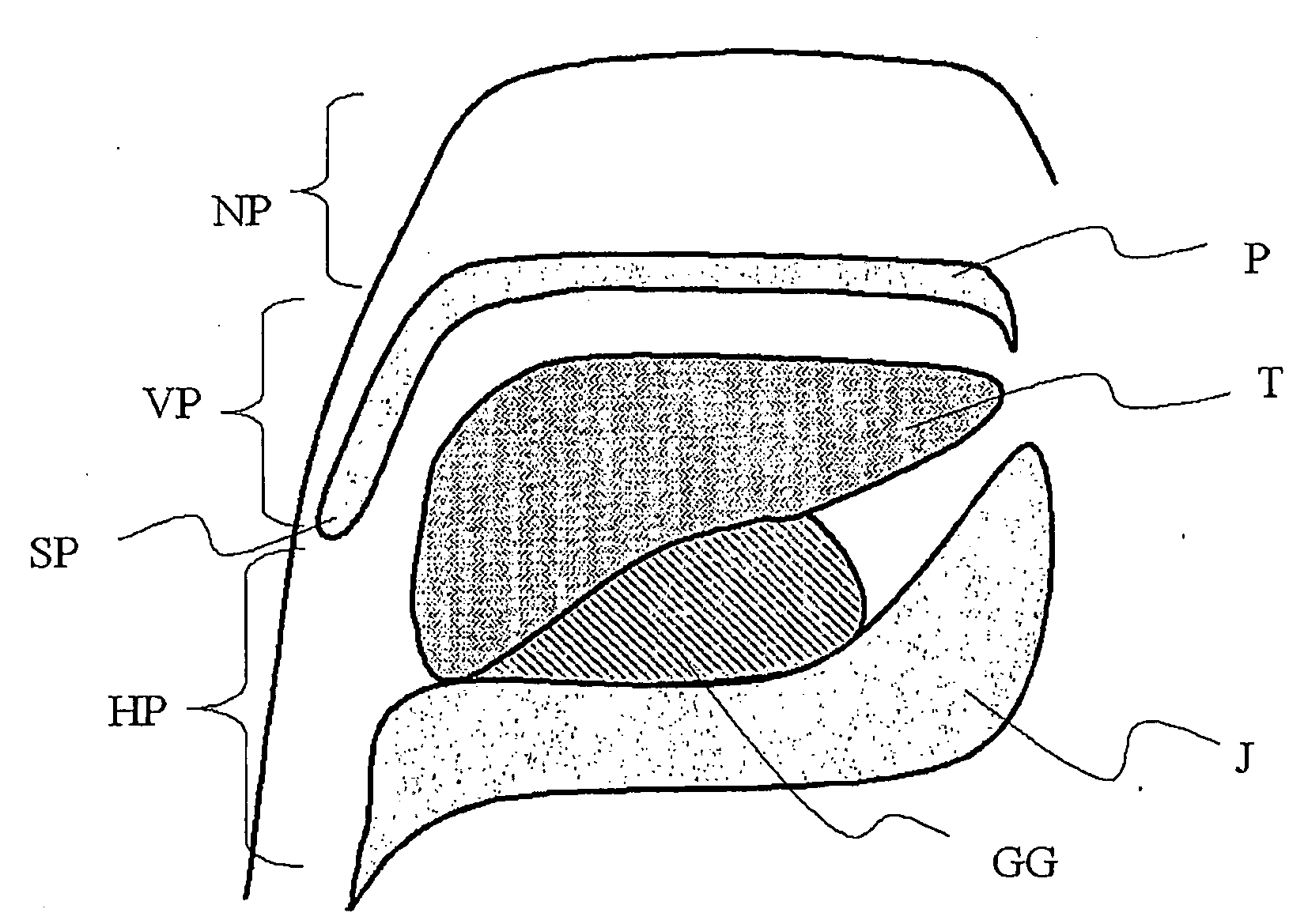 Method And Device For The Treatment Of Obstructive Sleep Apnea And Snoring