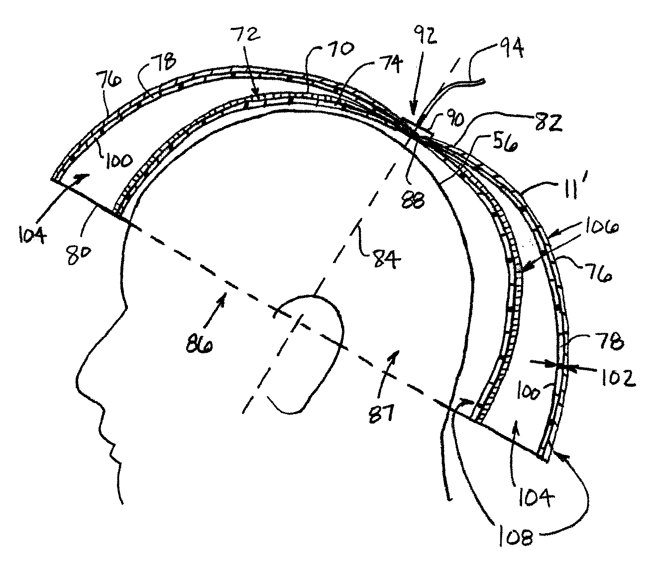 Shielded dome resonator for mr scanning of a cerebrum