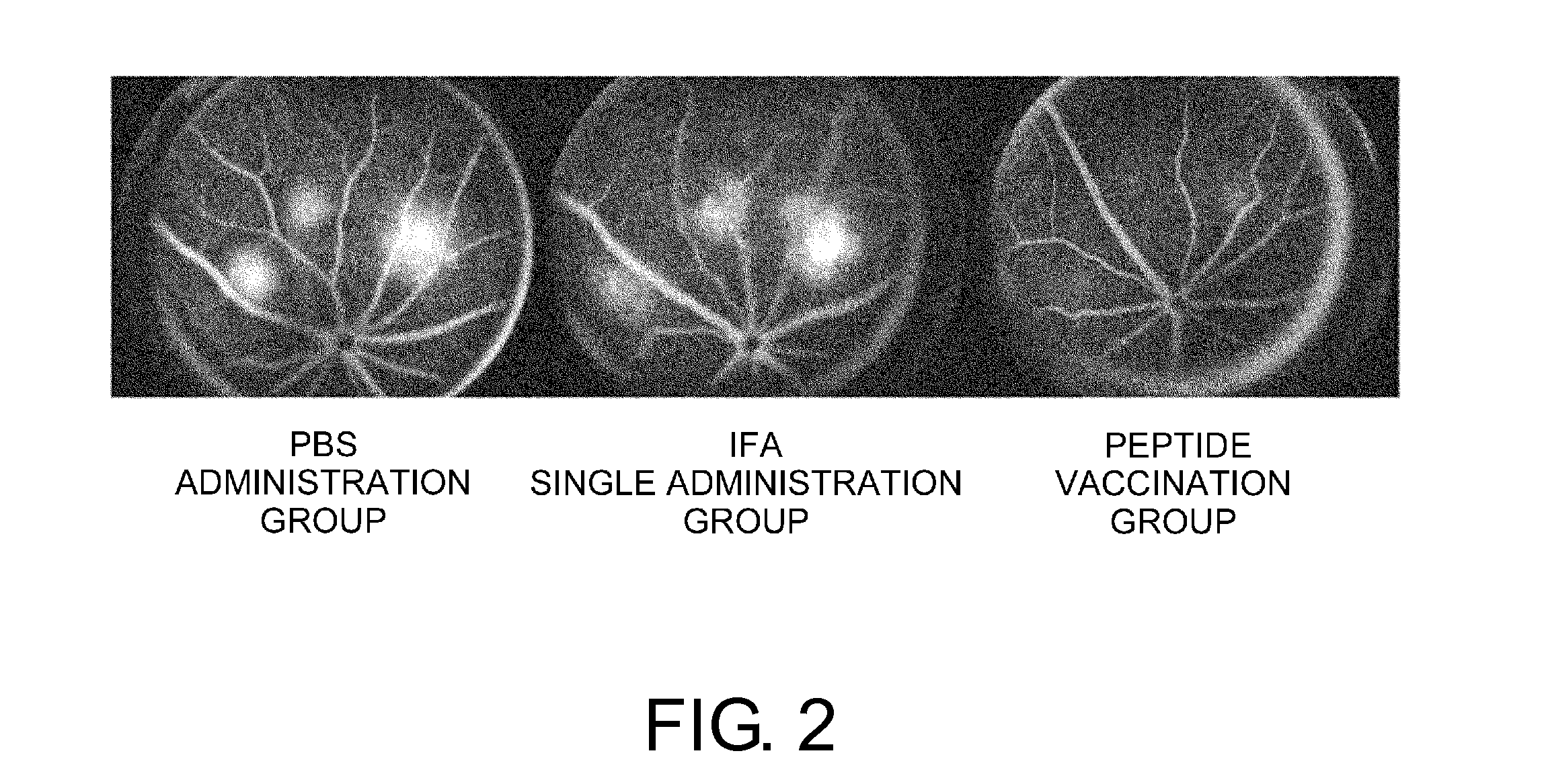 Vaccine therapy for choroidal neovascularization