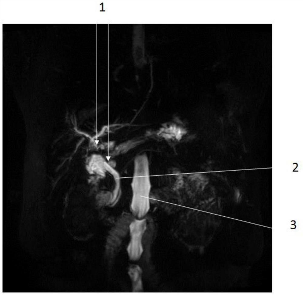 Guidewire navigation method and system for hilar stenosis in endoscopic biliary stent implantation