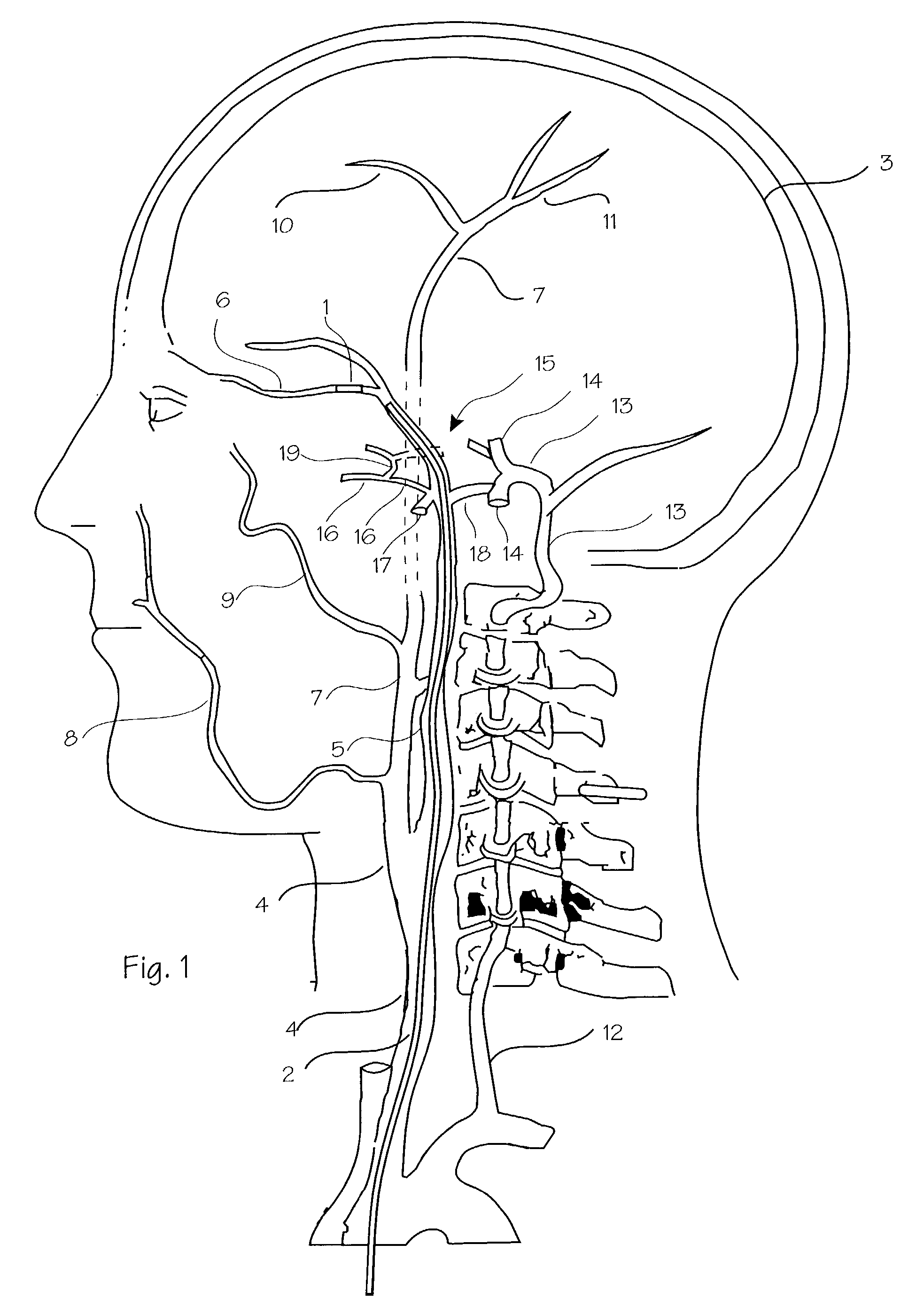 Intracranial stent and method of use