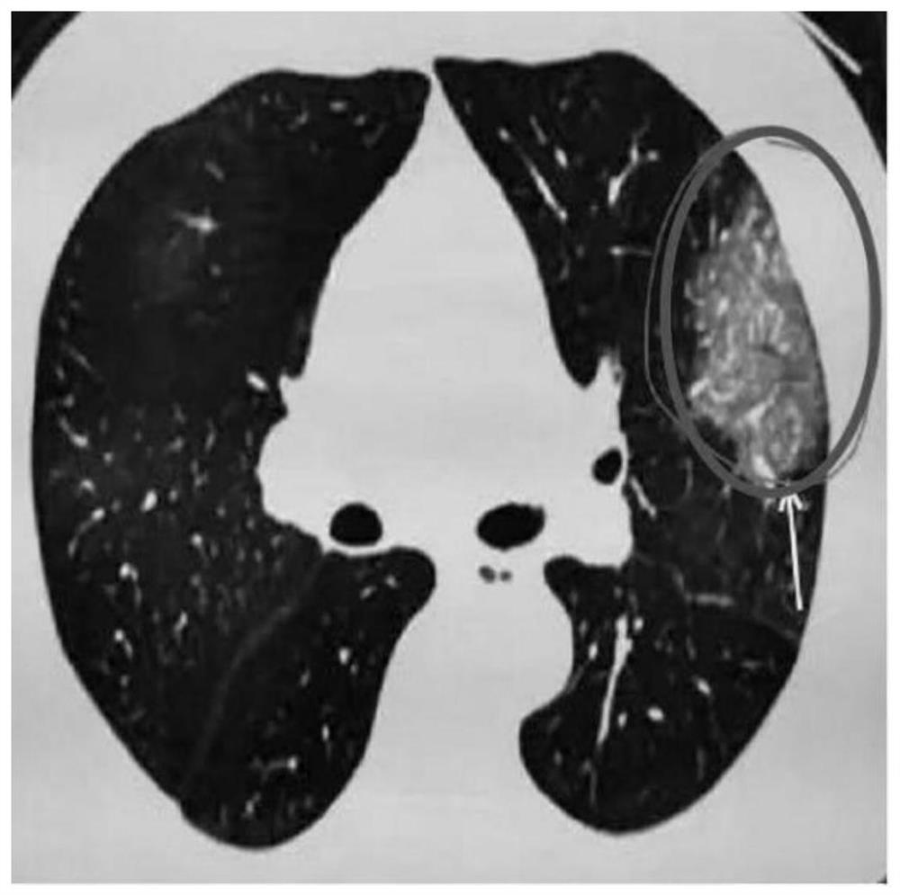 An Adaptive Median Filtering Method for CT Image Denoising