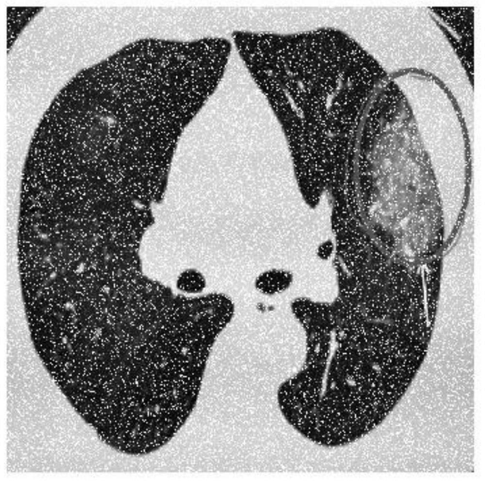 An Adaptive Median Filtering Method for CT Image Denoising