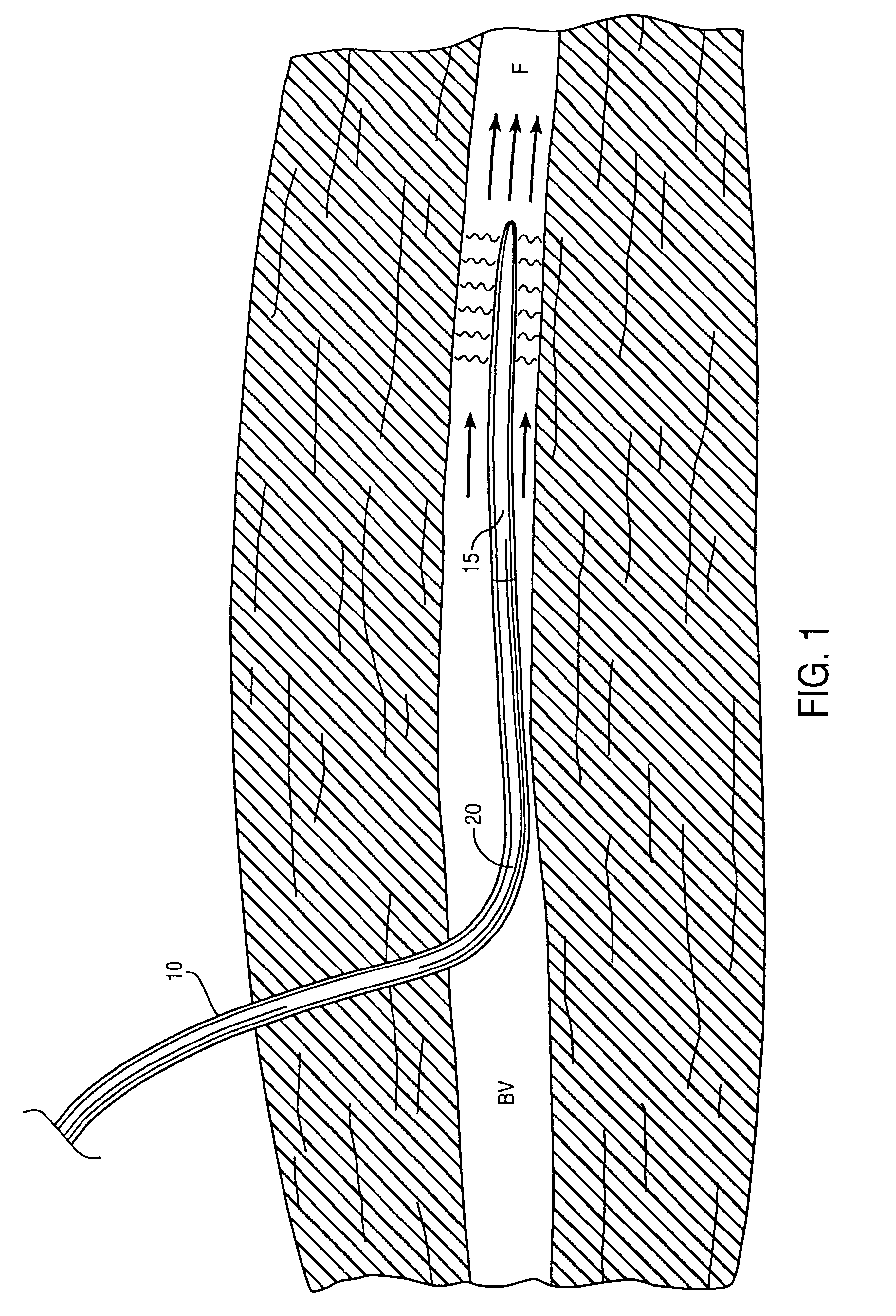 Catheter system for controlling a patient's body temperature by in situ blood temperature modification