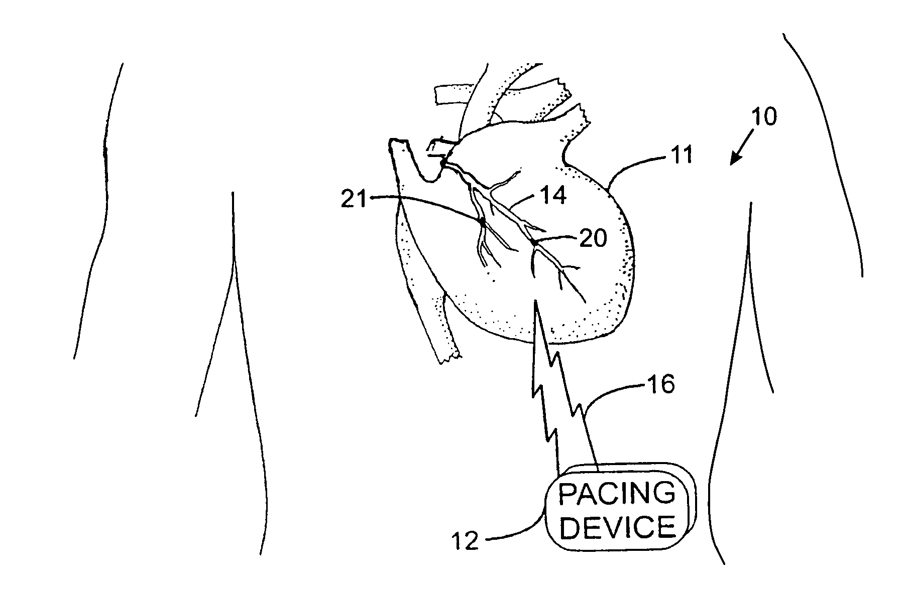 Implantable medical apparatus having an omnidirectional antenna for receiving radio frequency signals