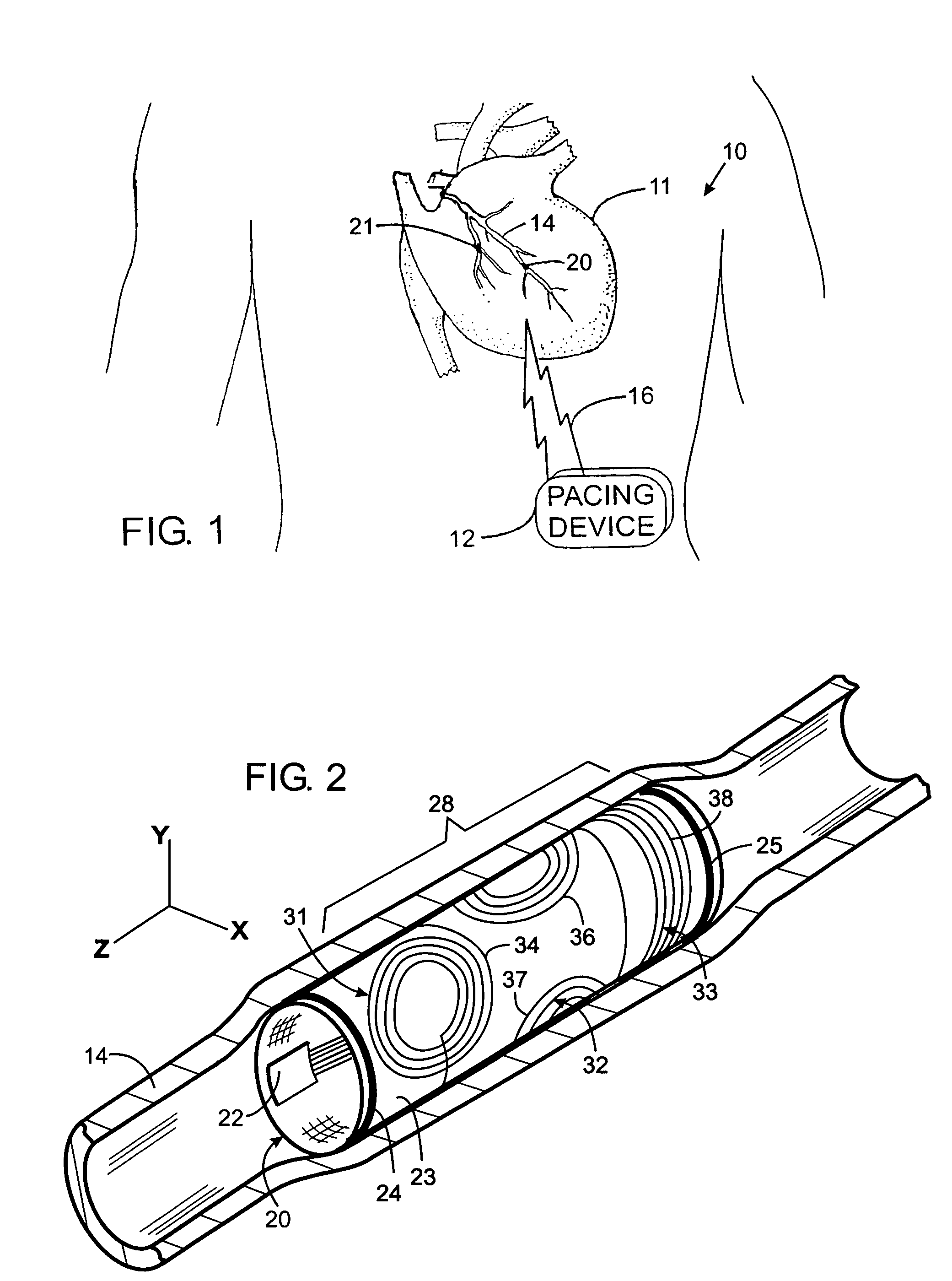 Implantable medical apparatus having an omnidirectional antenna for receiving radio frequency signals