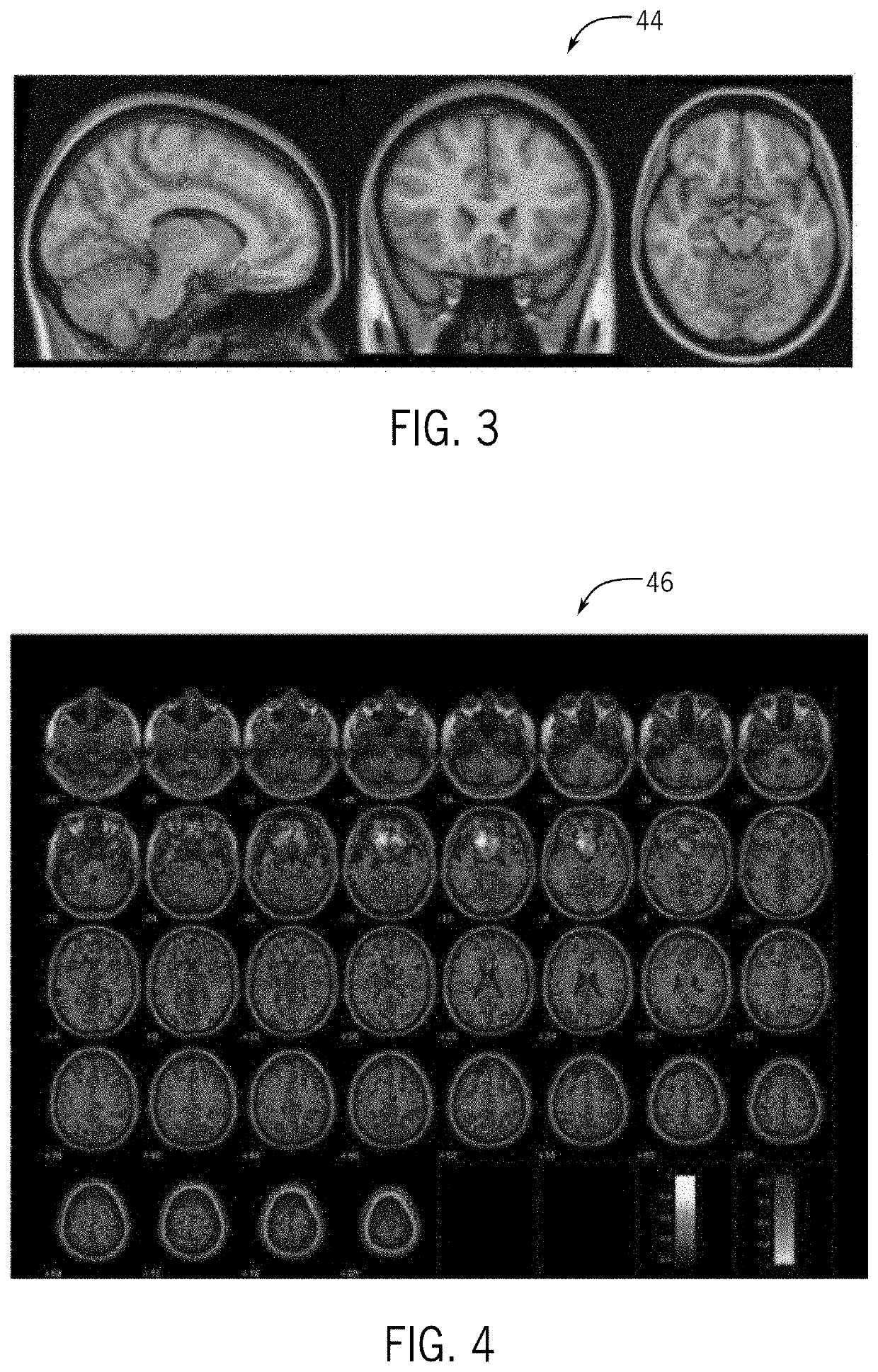 Brain connectivity atlas for personalized functional neurosurgery targeting and brain stimulation programming