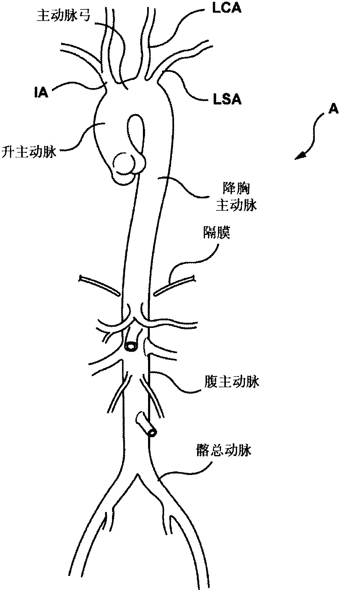 Endoluminal prosthetic devices having fluid-absorbable compositions for repair of a vascular tissue defect